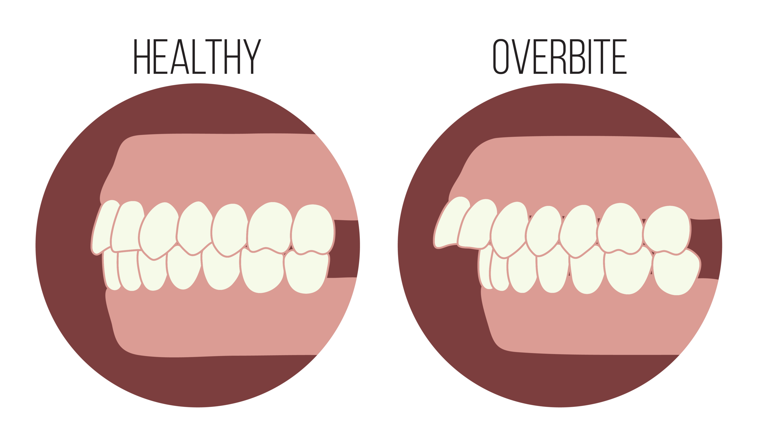 How To Fix Overbite