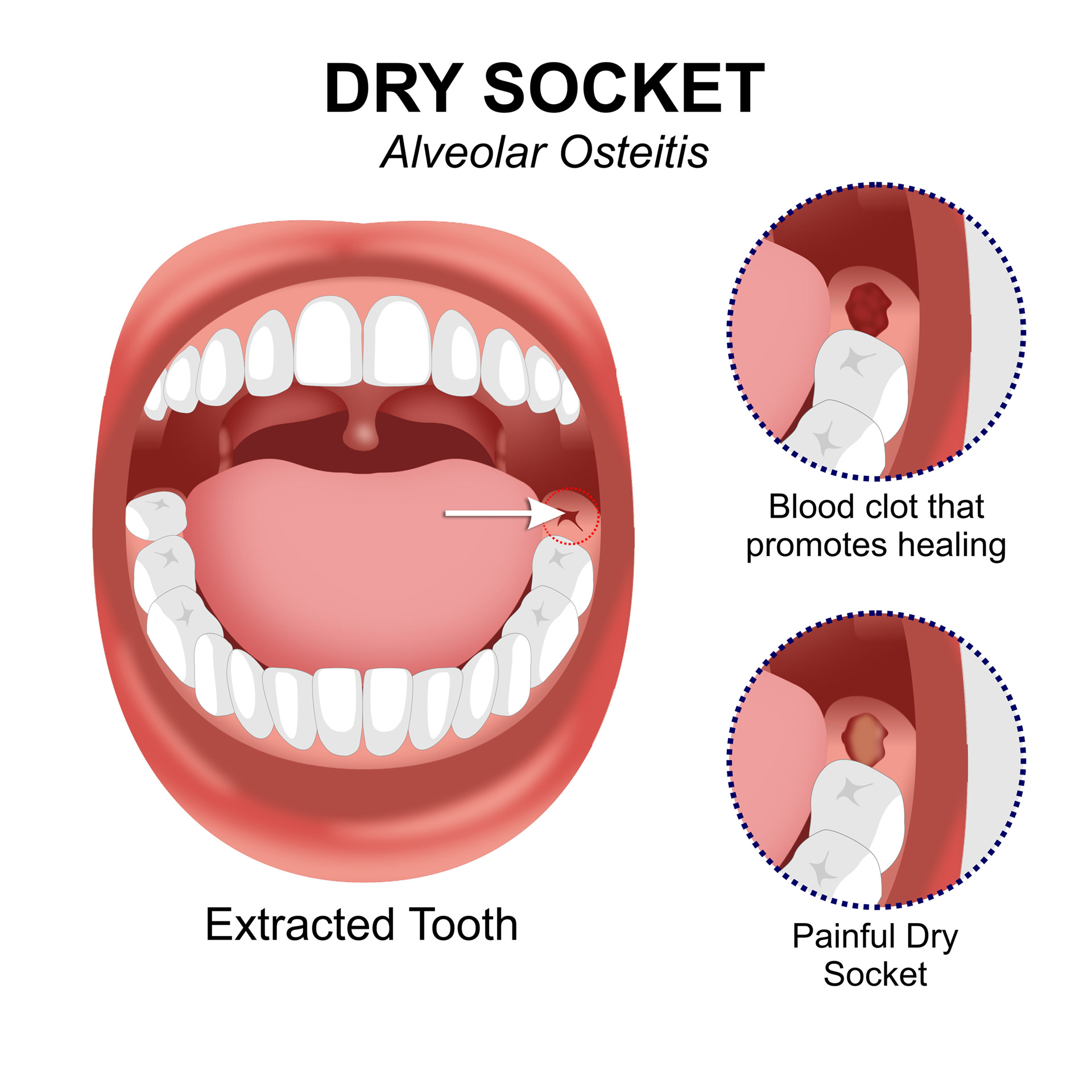 How To Get Dry Socket