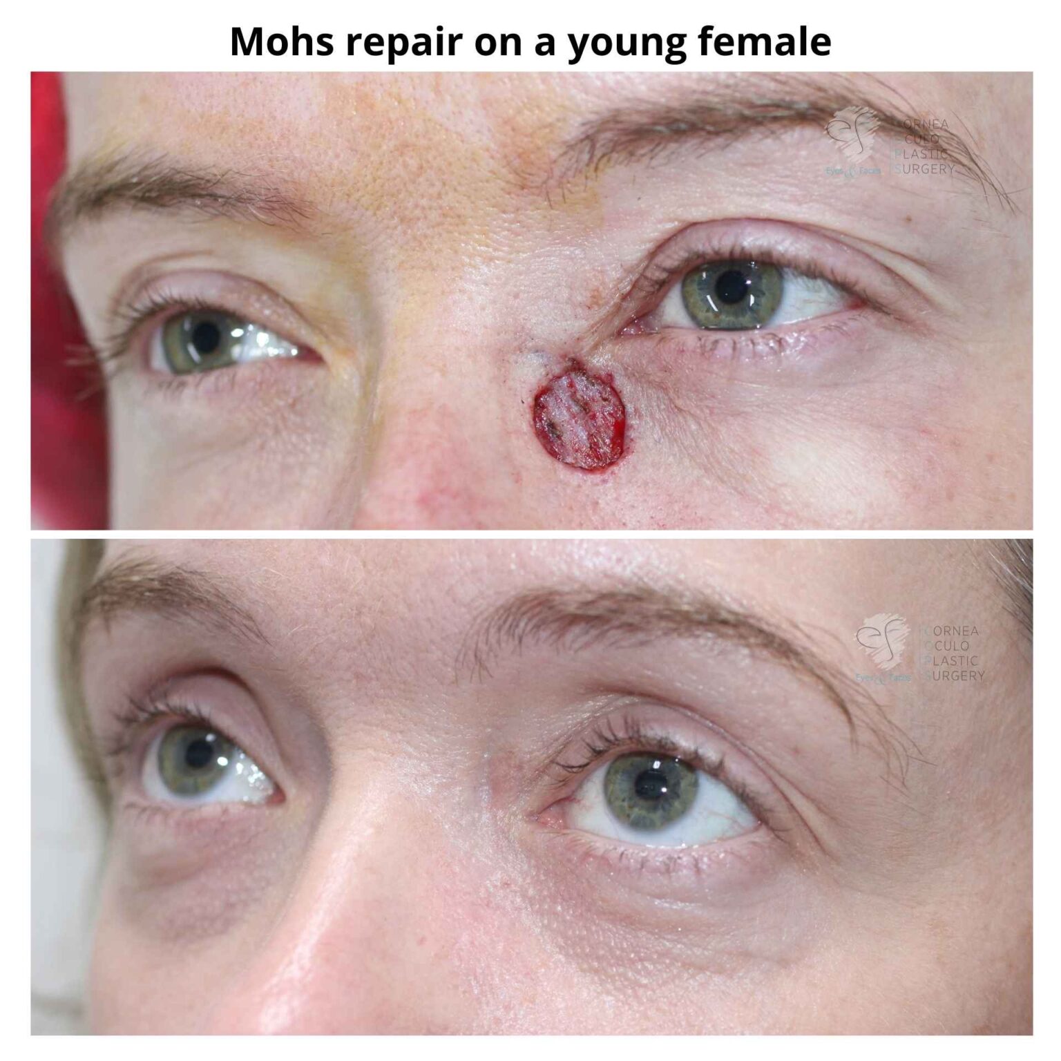 How To Prepare For Mohs Surgery On Face