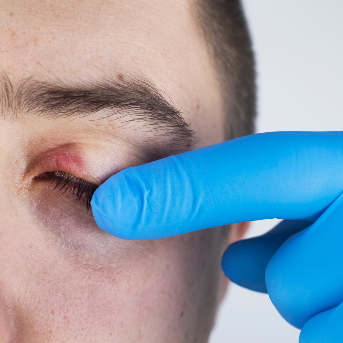 How To Reduce Eye Itching
