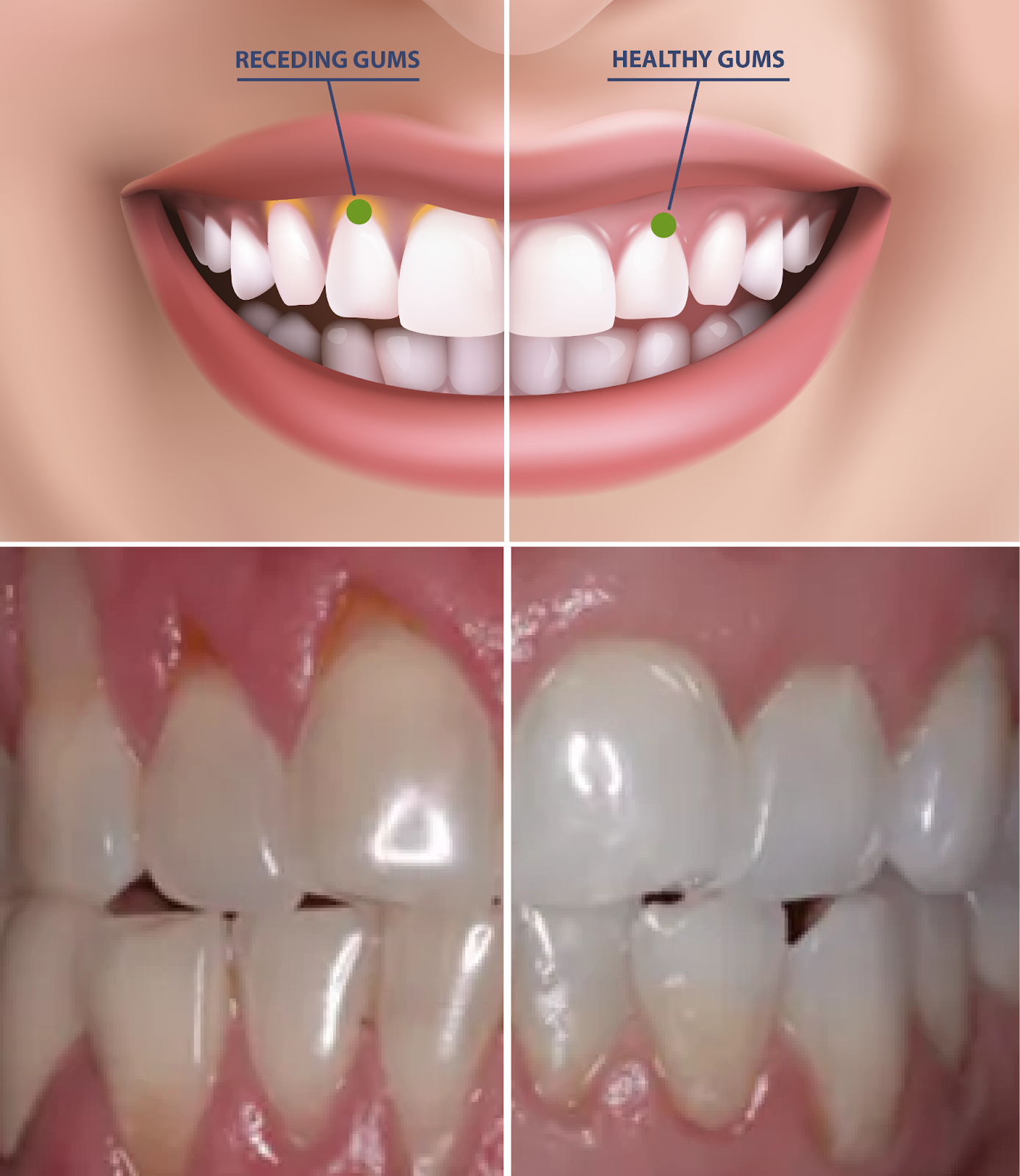 How To Stop Receding Gums