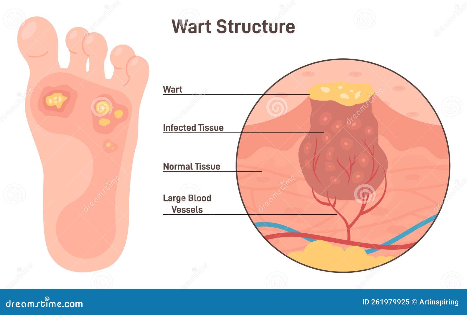 Human Papillomavirus Infection On Foot