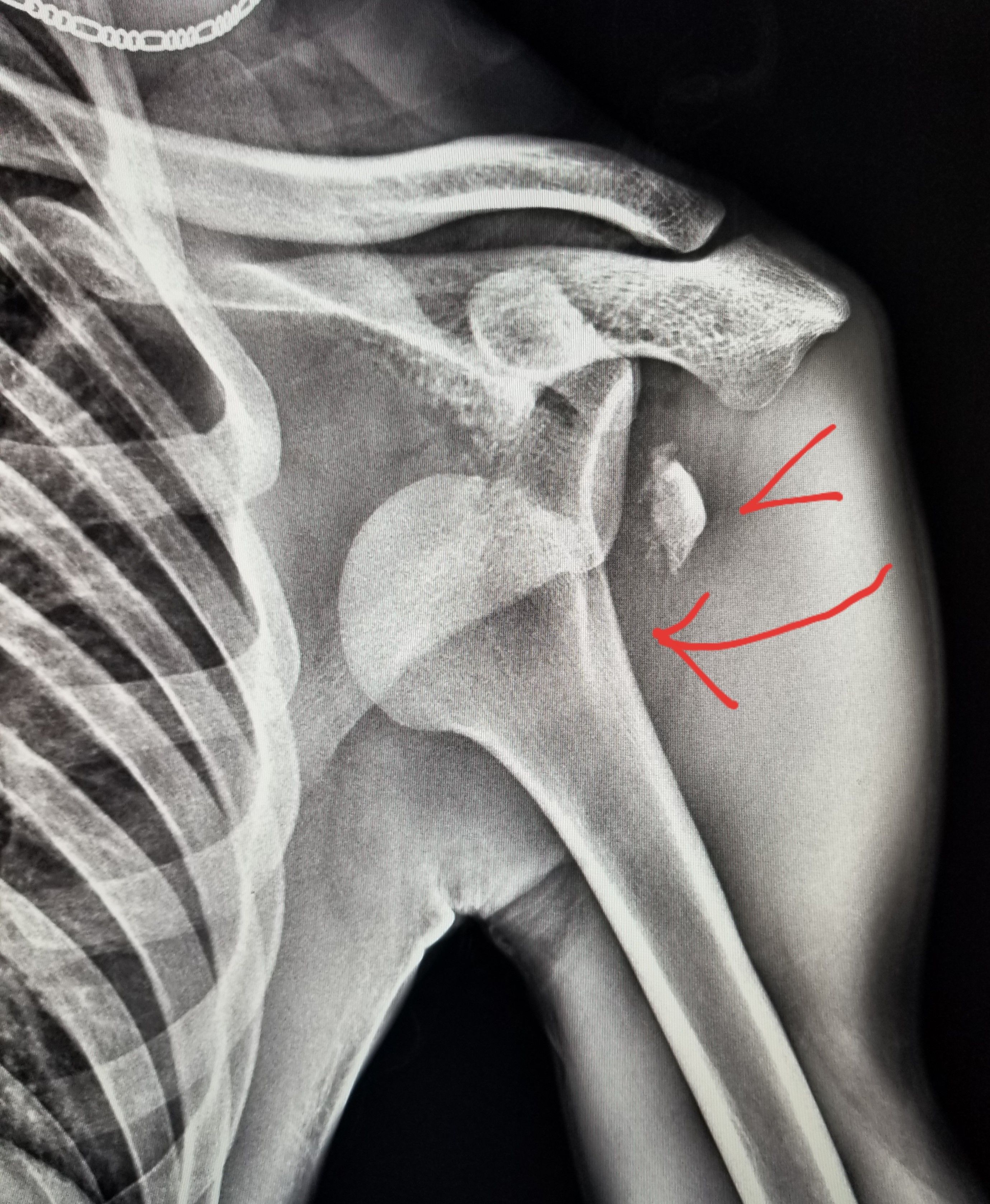 Humeral Head Fracture