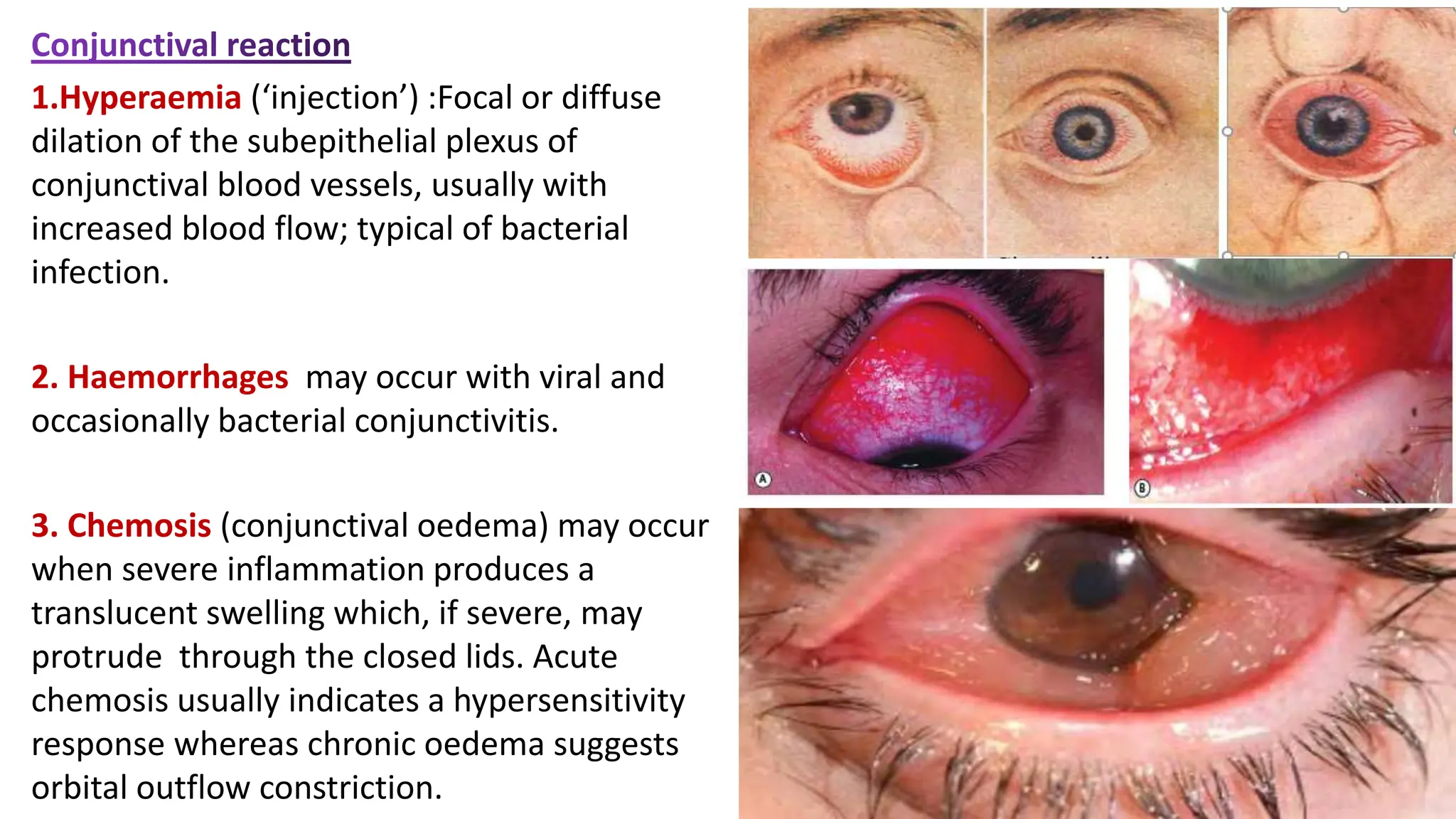 Hyperaemia Of Conjunctiva