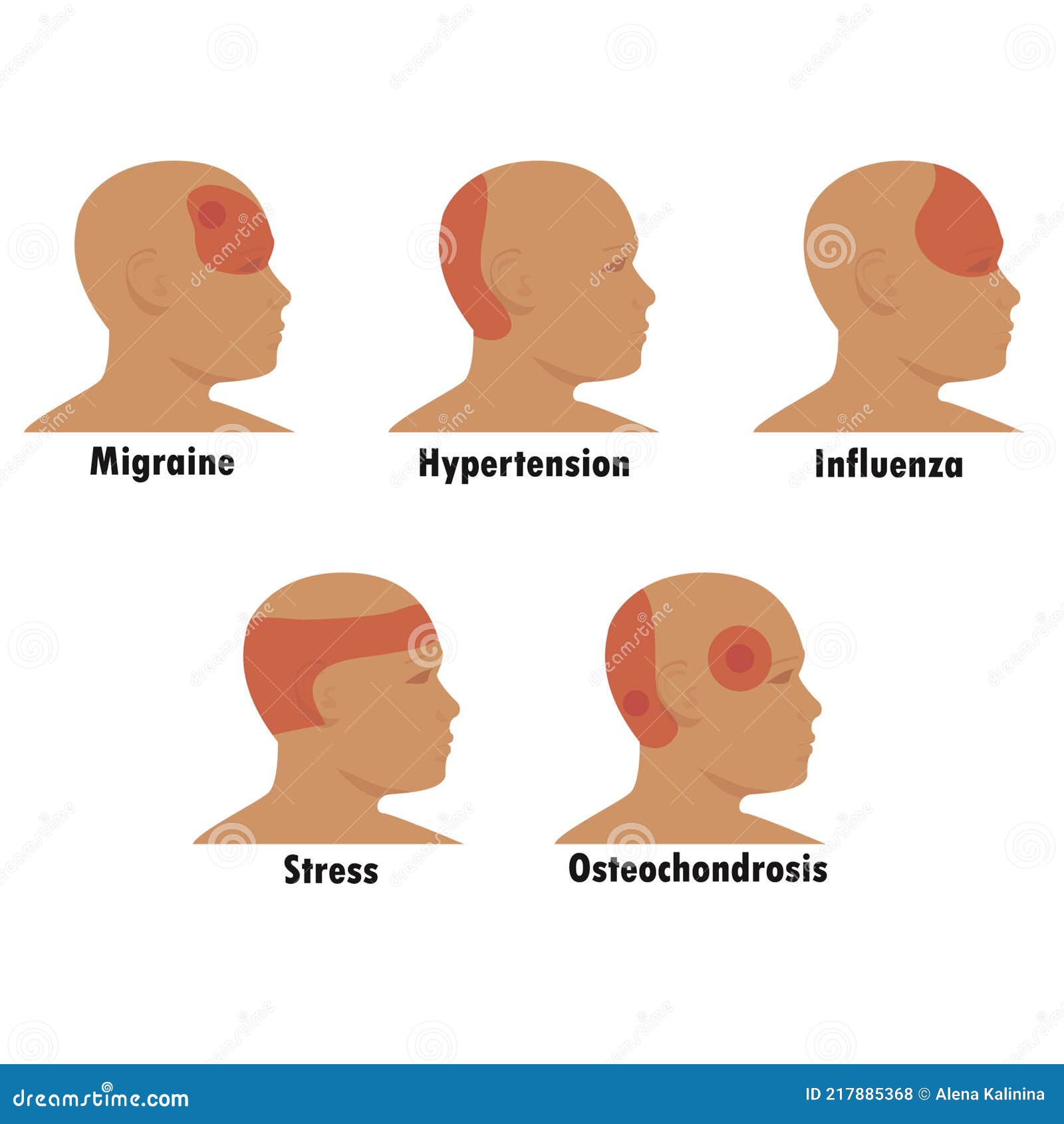 Hypertension Headache Location