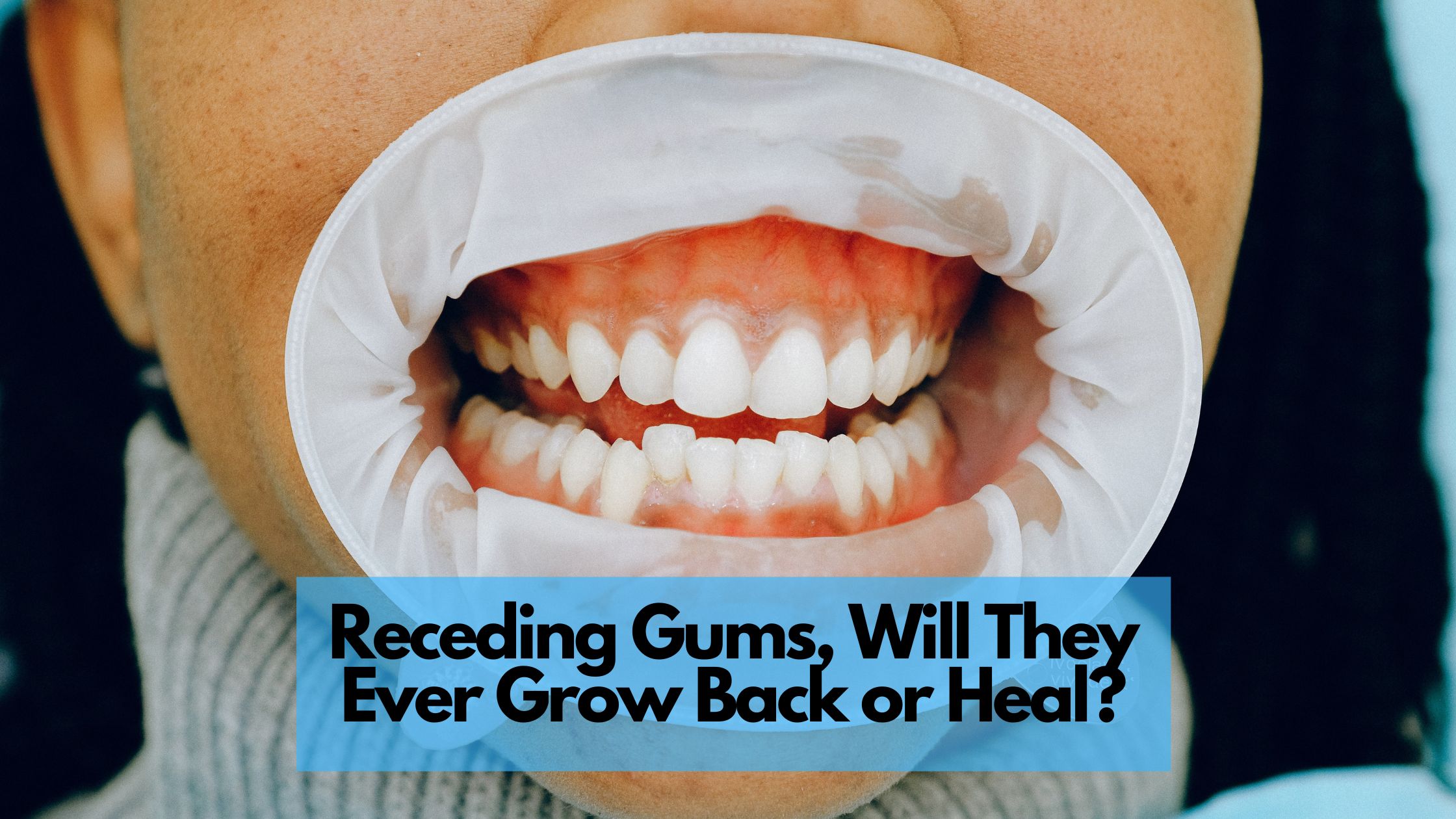 I Healed My Receding Gums