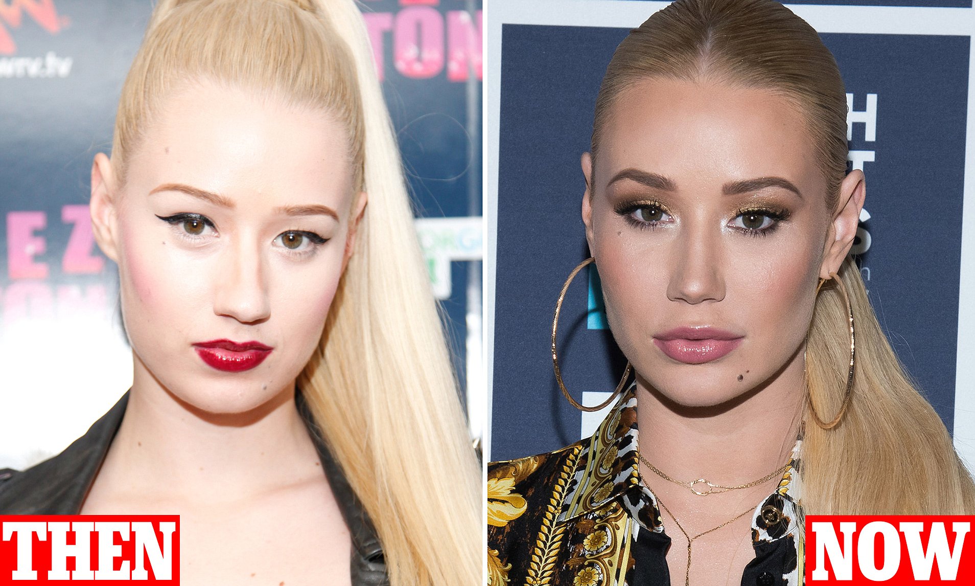 Iggy Azalea Face Surgery
