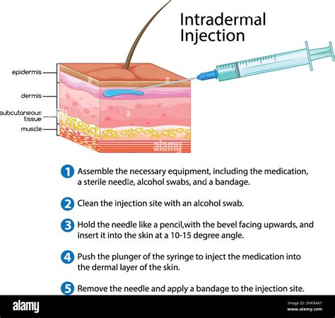 Illustration Of Intradermal Injection