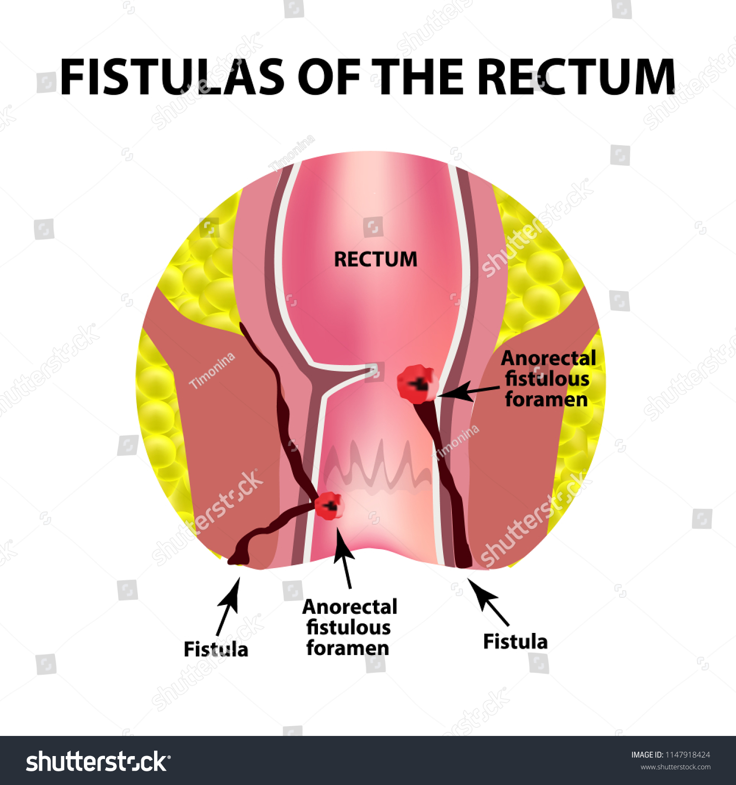 Image Of Anus Fistula