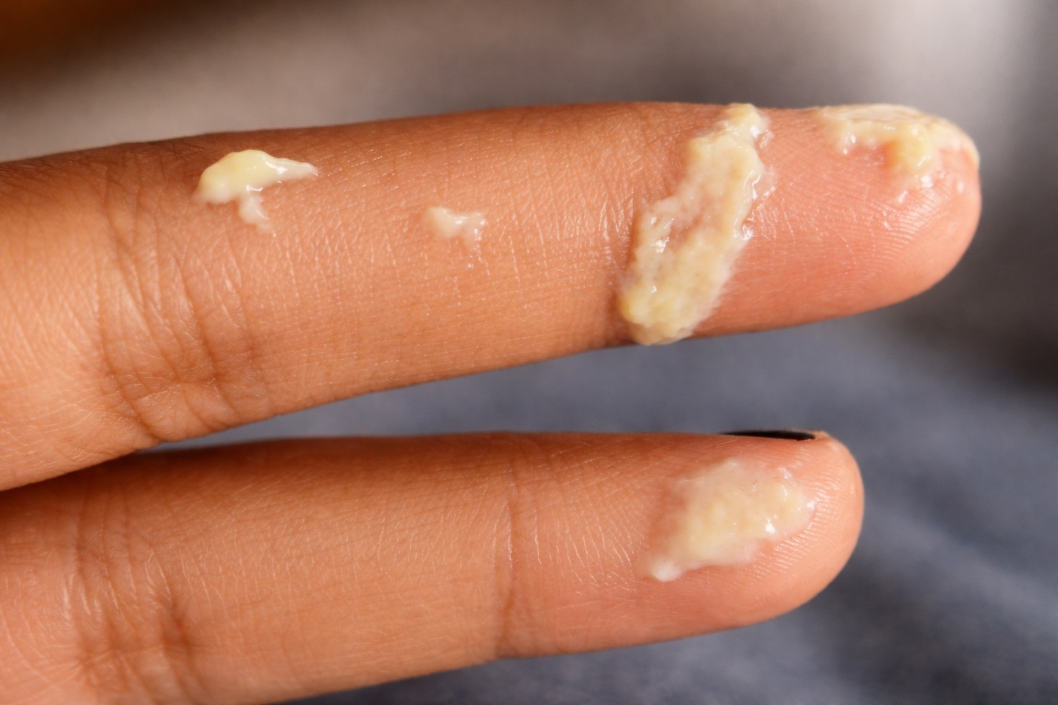 Image Of Yeast Infection Discharge