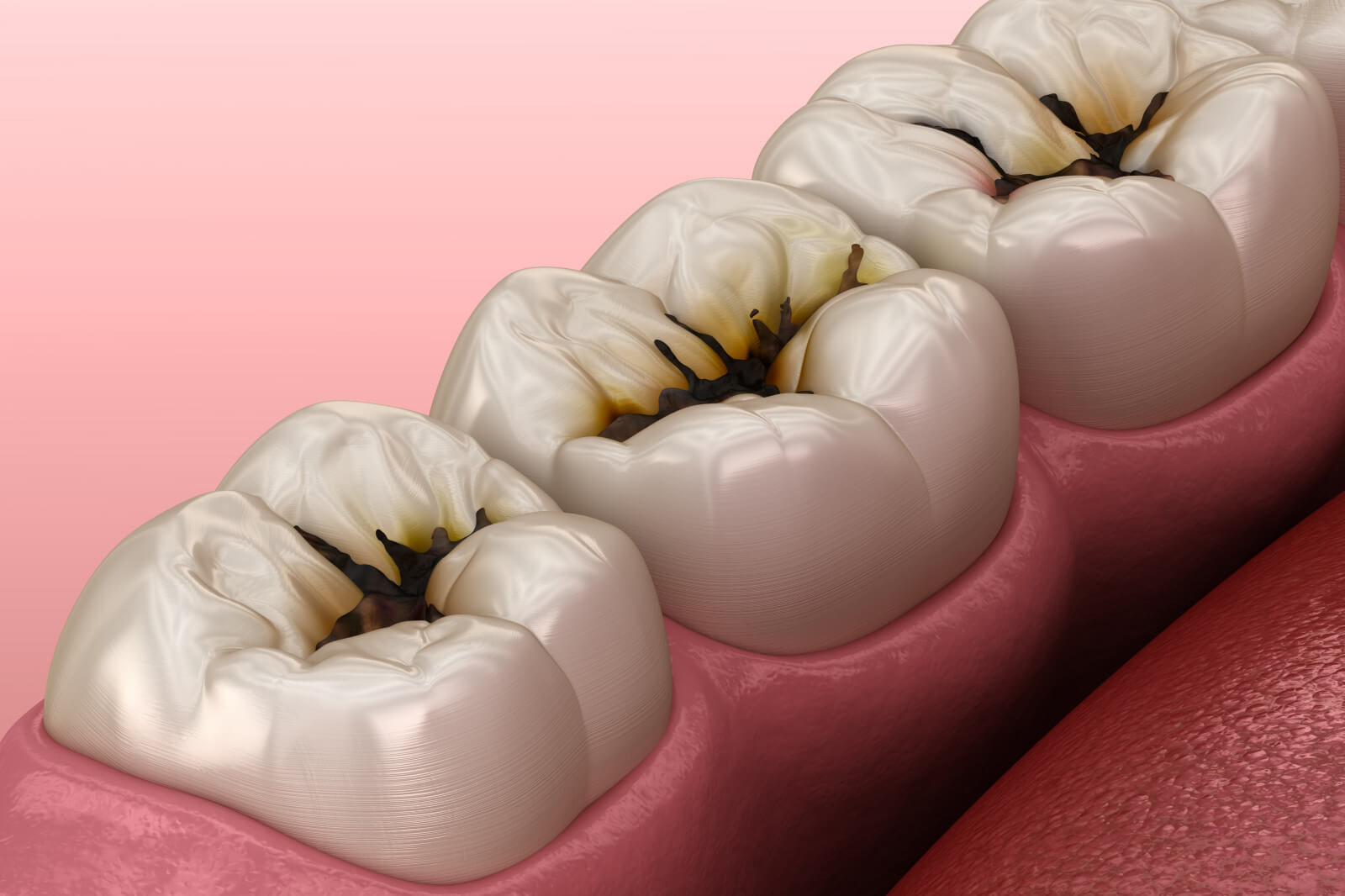 Images Of Cavity Teeth