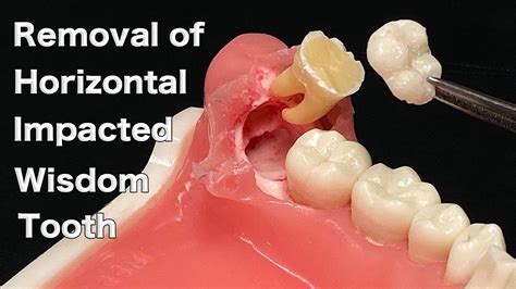 Impacted Wisdom Teeth Removal