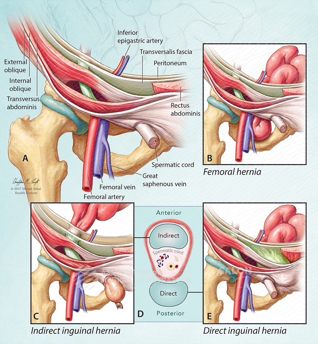 Indirect Hernia Vs Direct