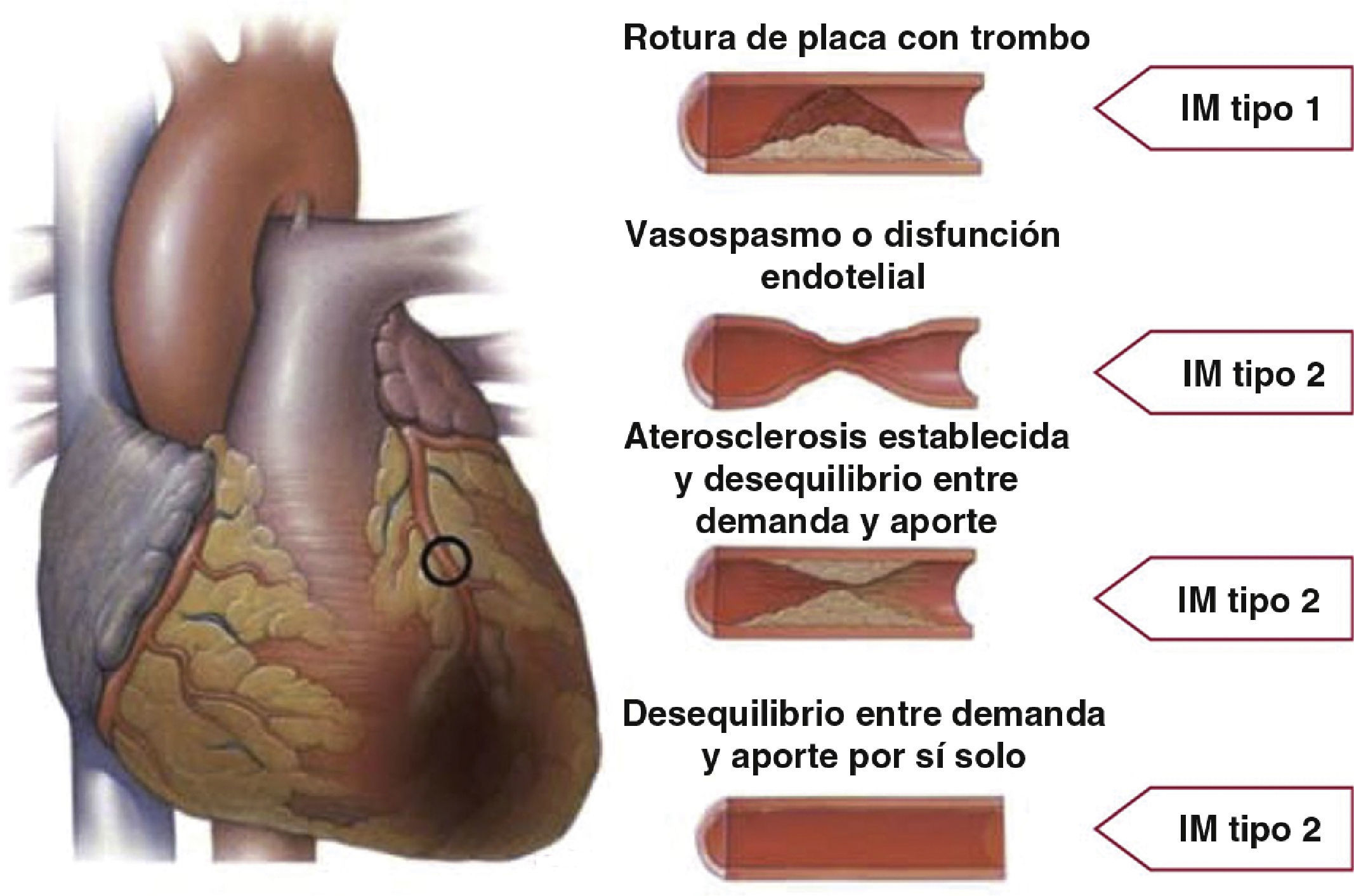 Infarto In English