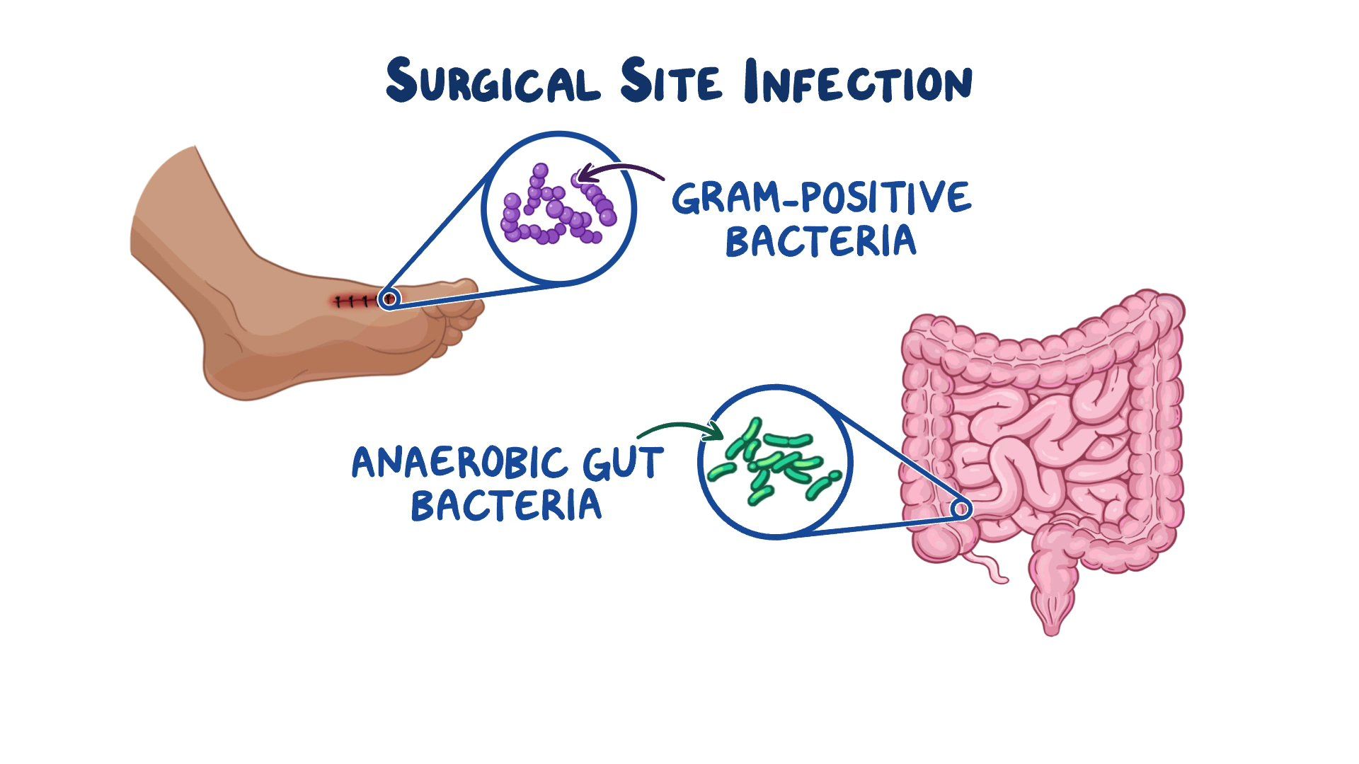 Infection After Surgery Signs