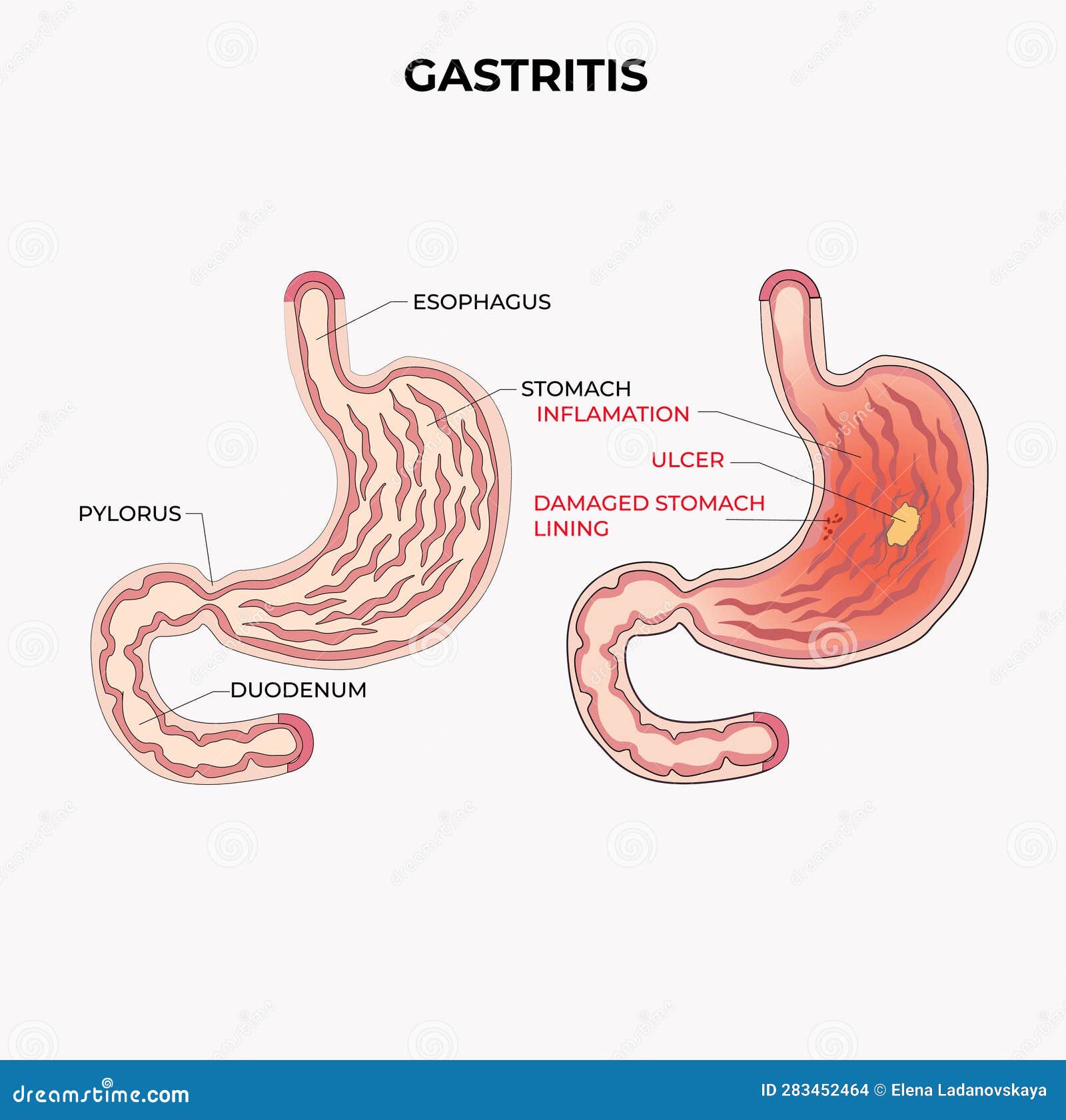 Inflamacion Del Estomago