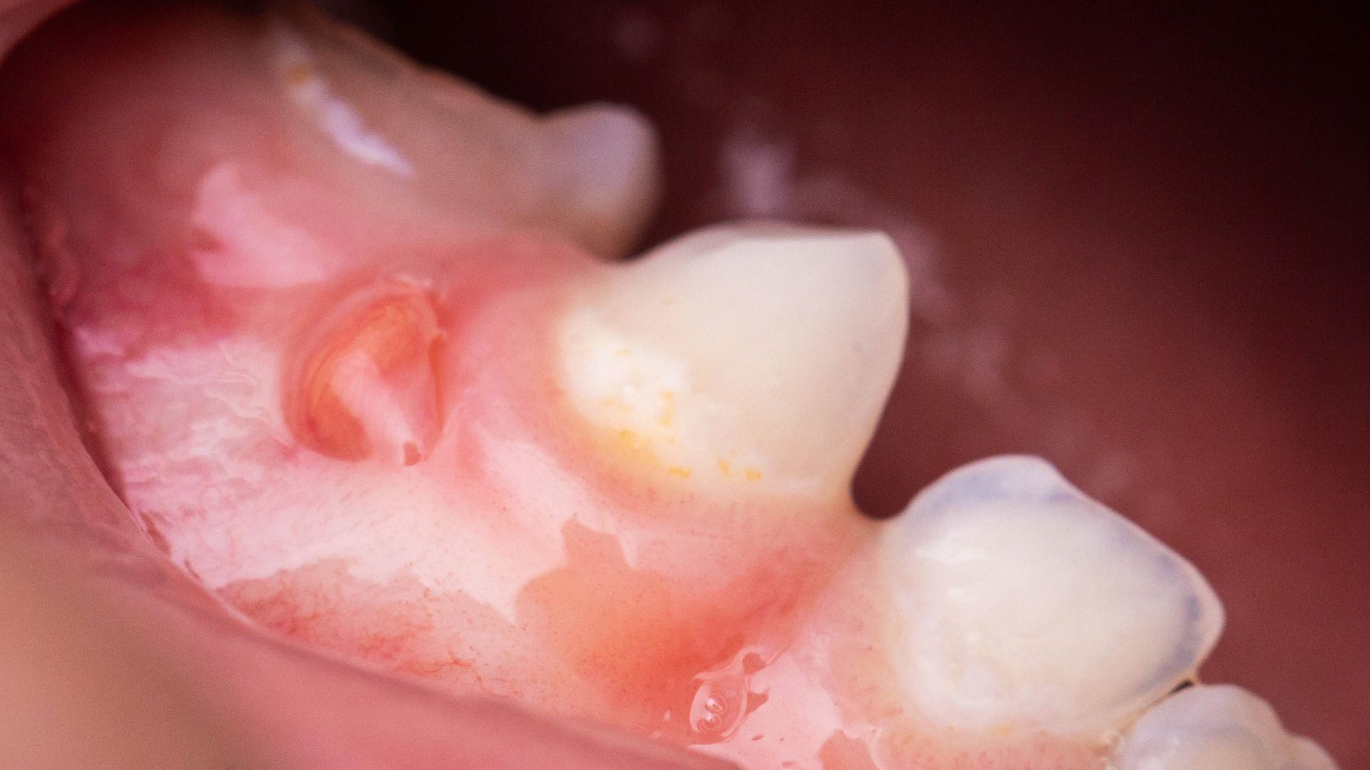 Inflamed Gum Around Tooth