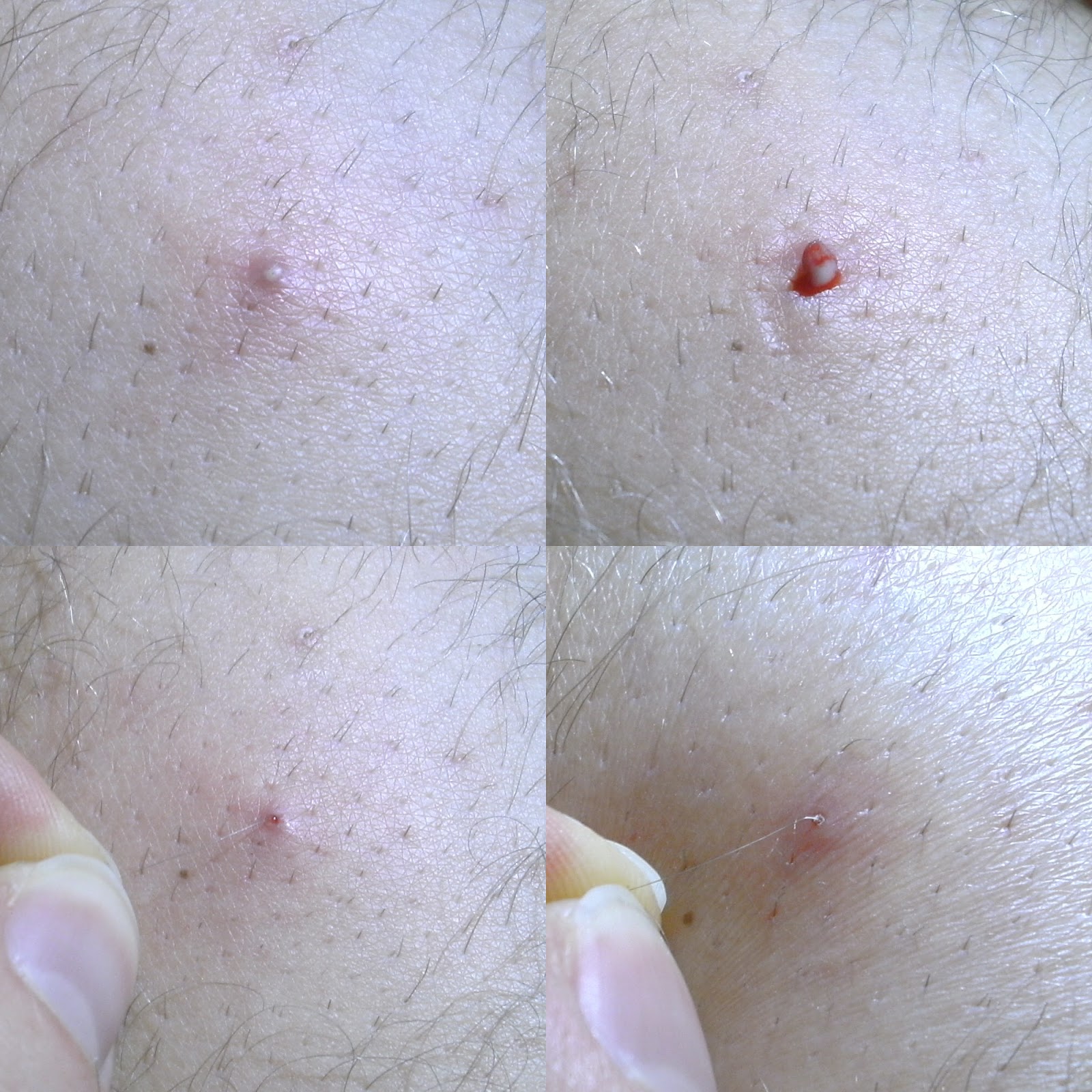 Ingrown Hair On Virgina