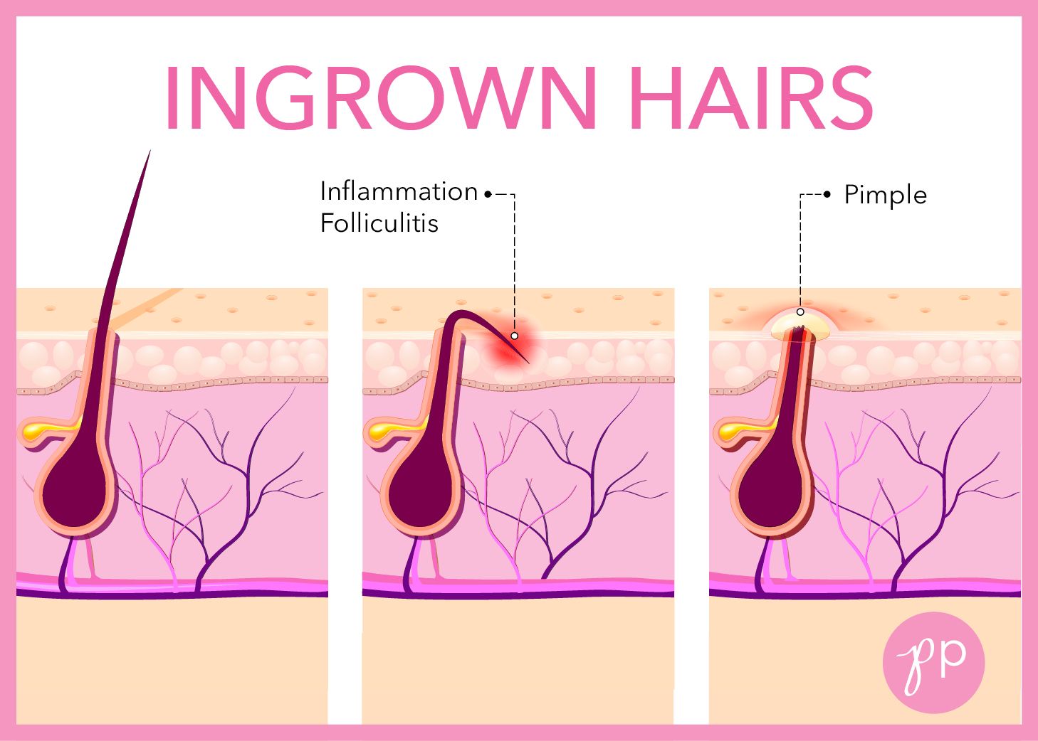 Ingrown Hair Penile