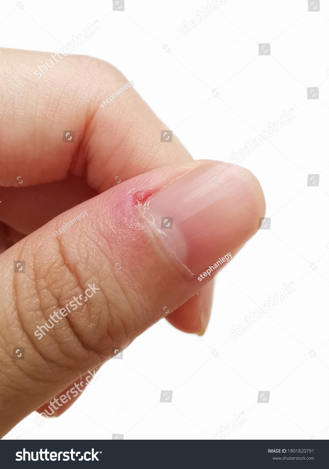 Ingrown Thumb Nail
