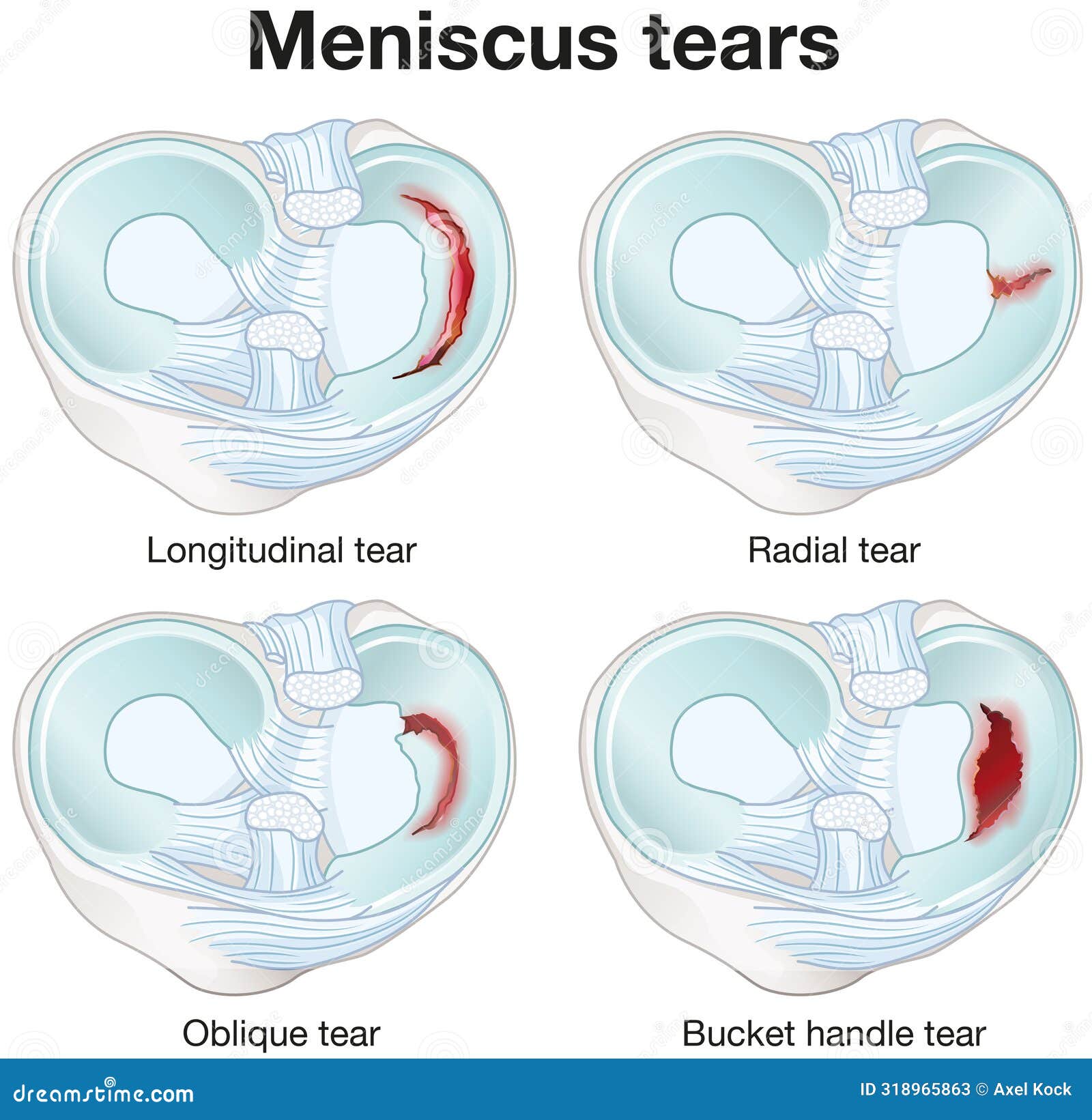 Injury To Lateral Meniscus