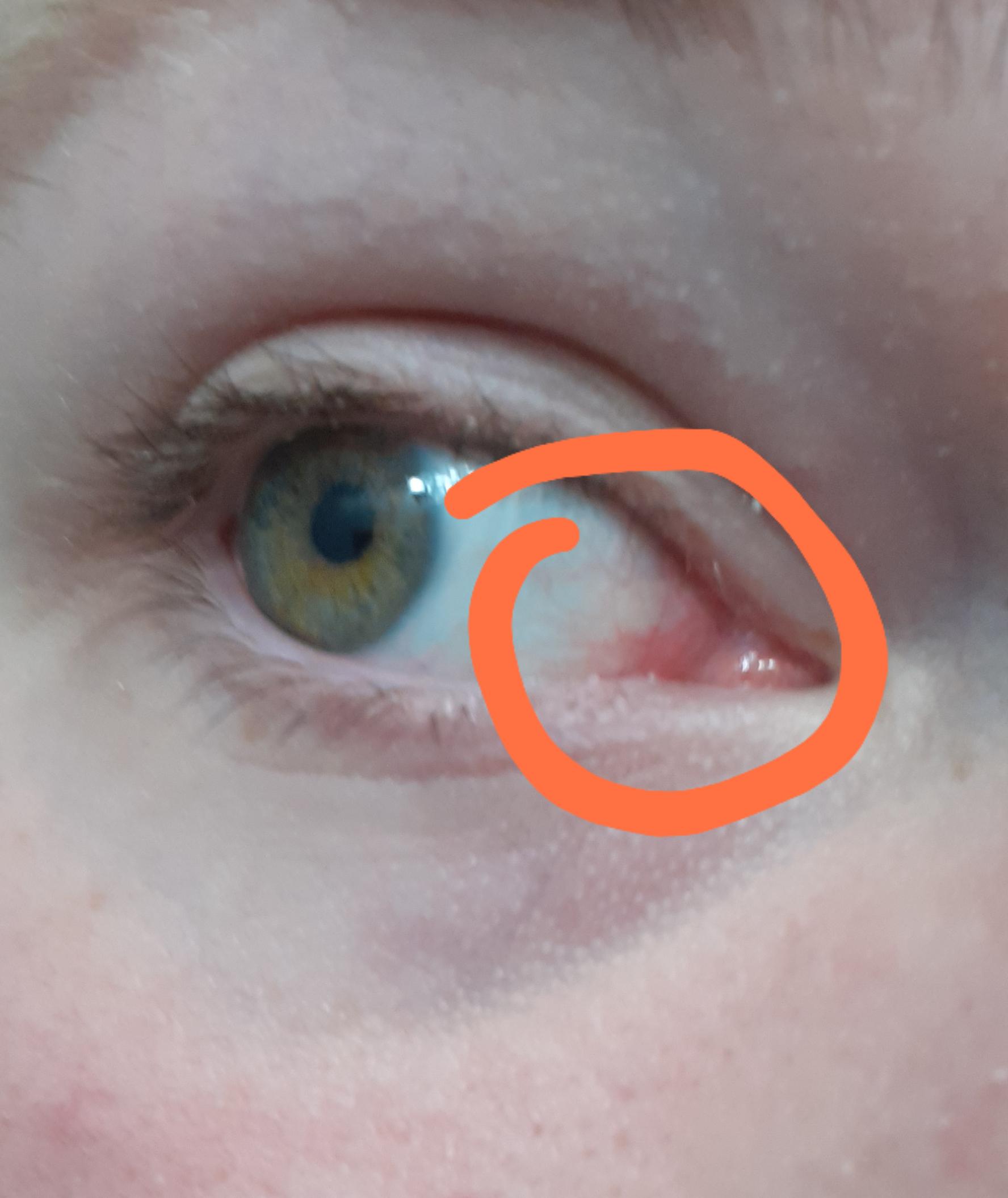 Inner Corner Of Eye Itchy