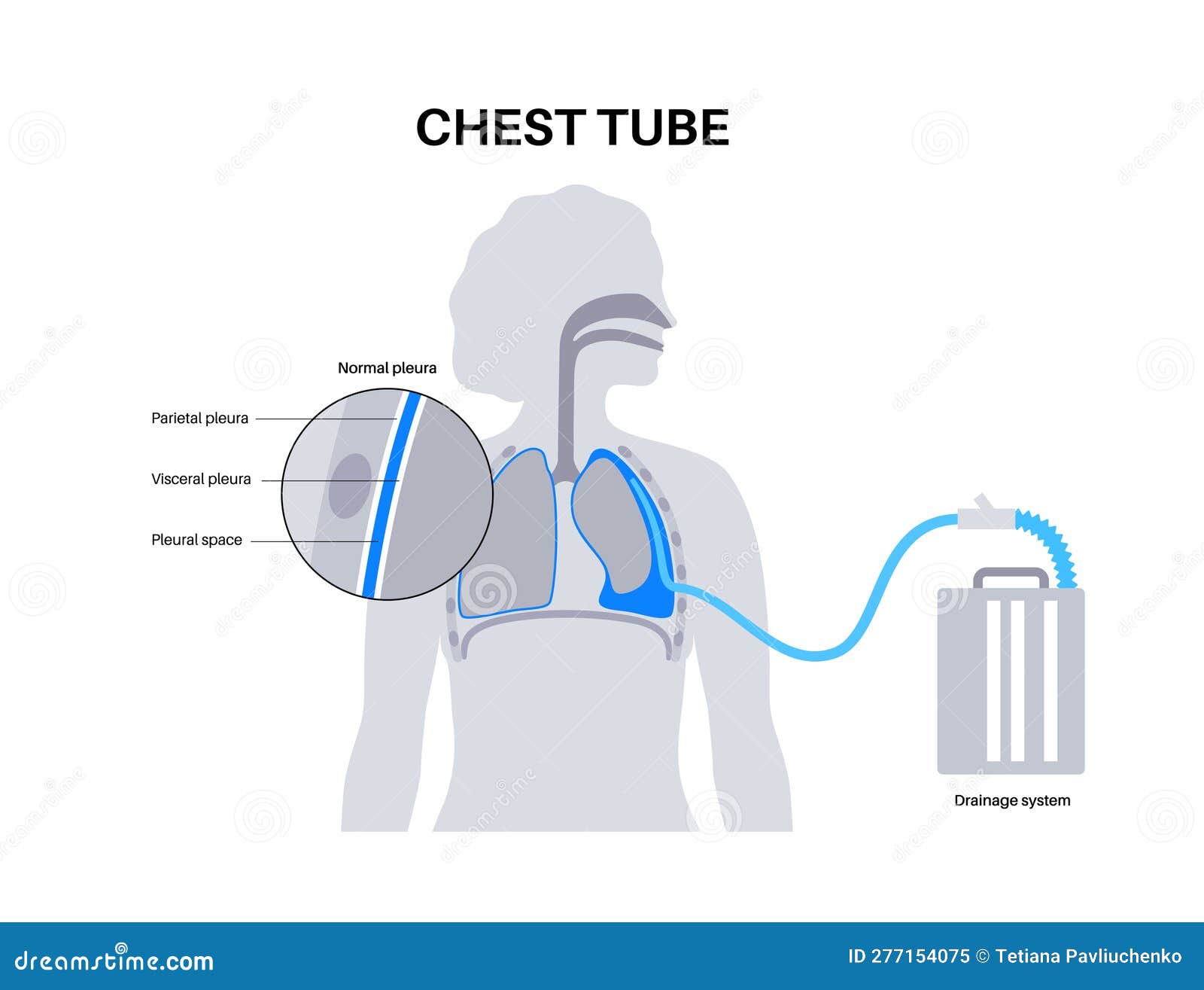 Inserting A Chest Tube