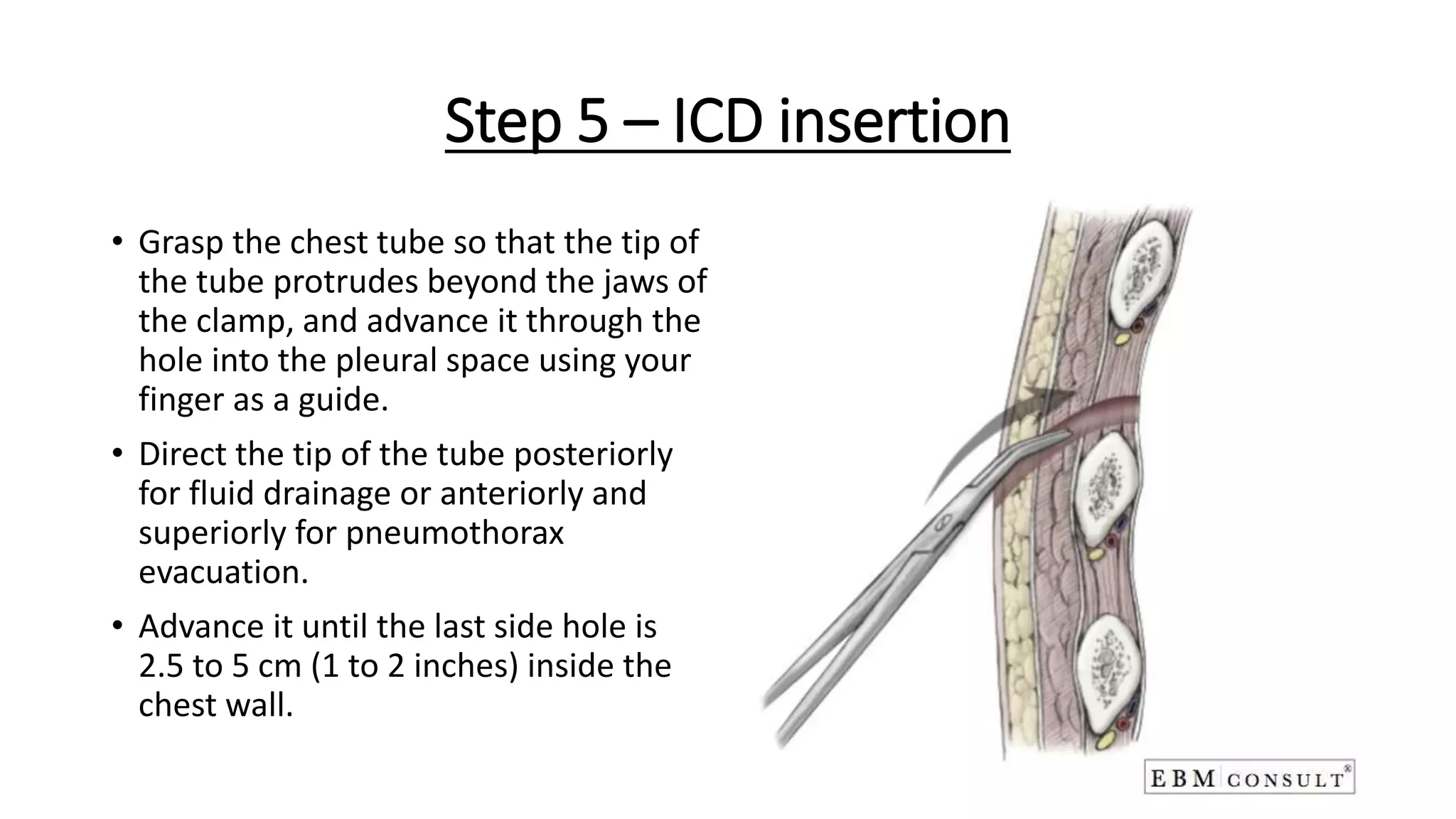 Insertion Of Intercostal Drainage