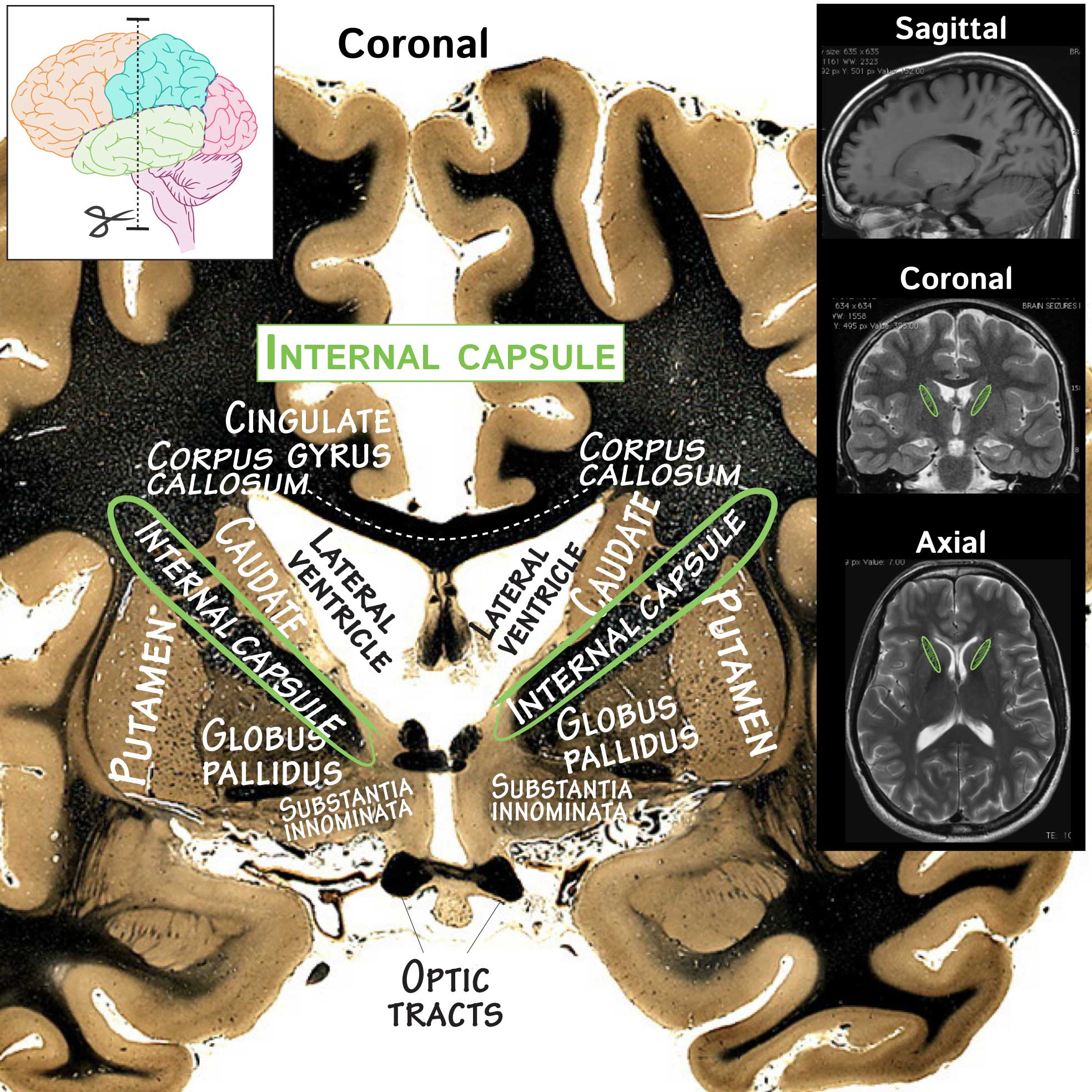 Internal Capsule Brain