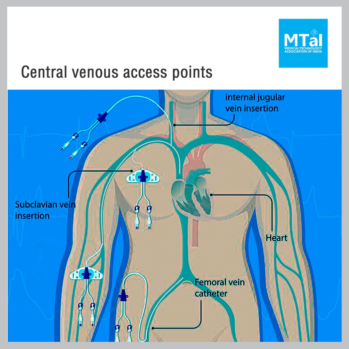 Internal Jugular Central Venous Line