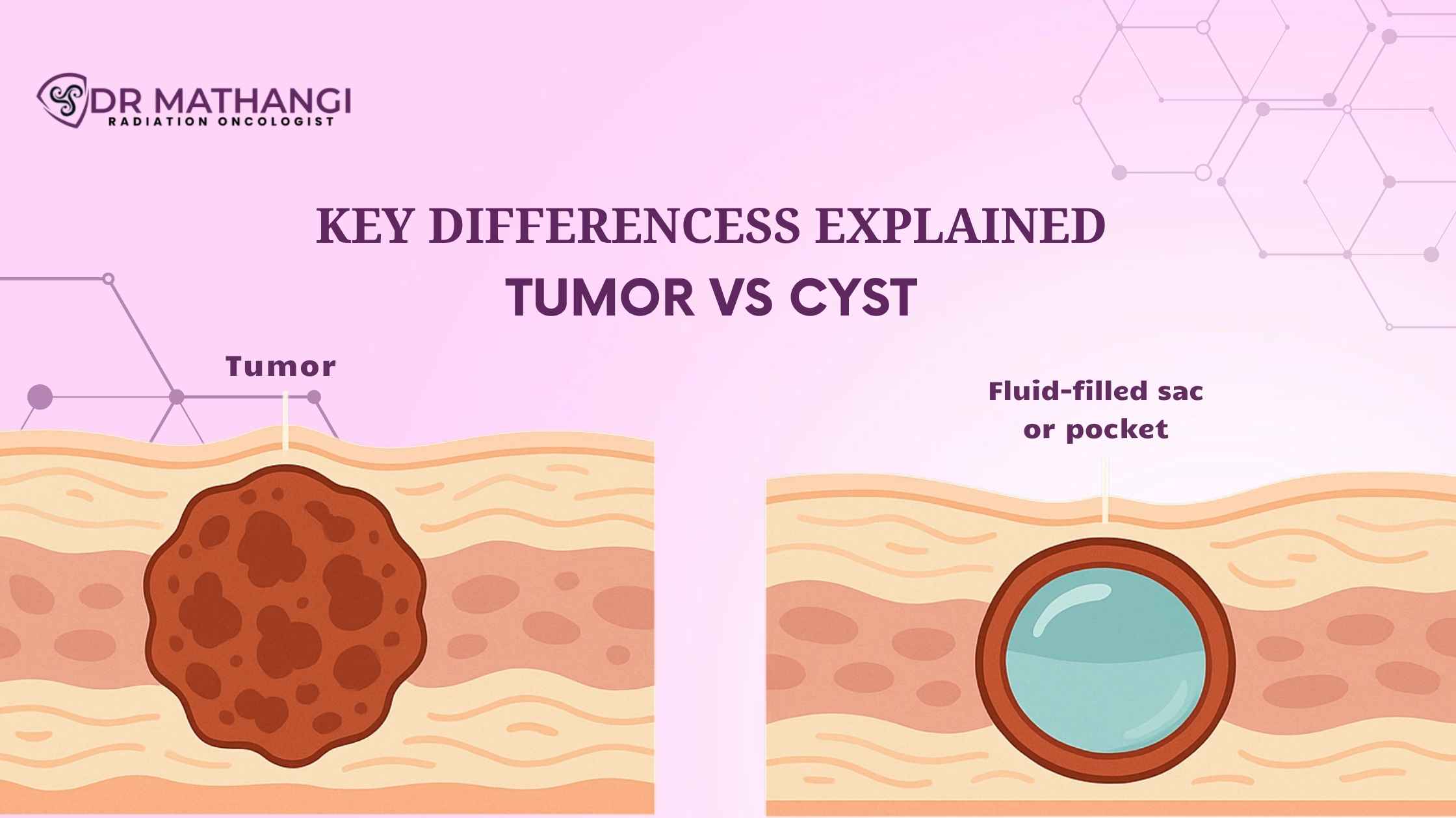 Is A Cyst A Tumor