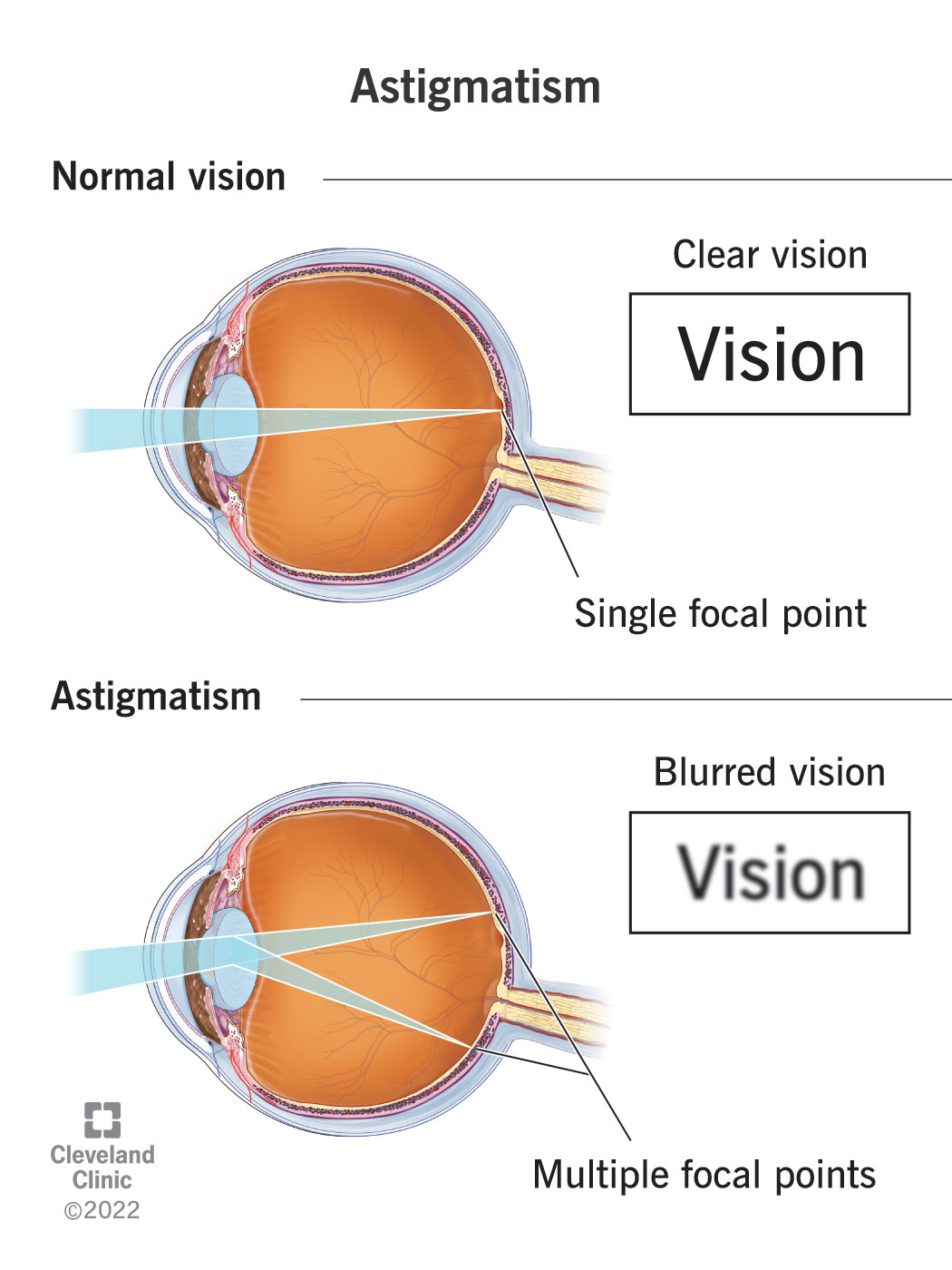 Is Astigmatism Bad