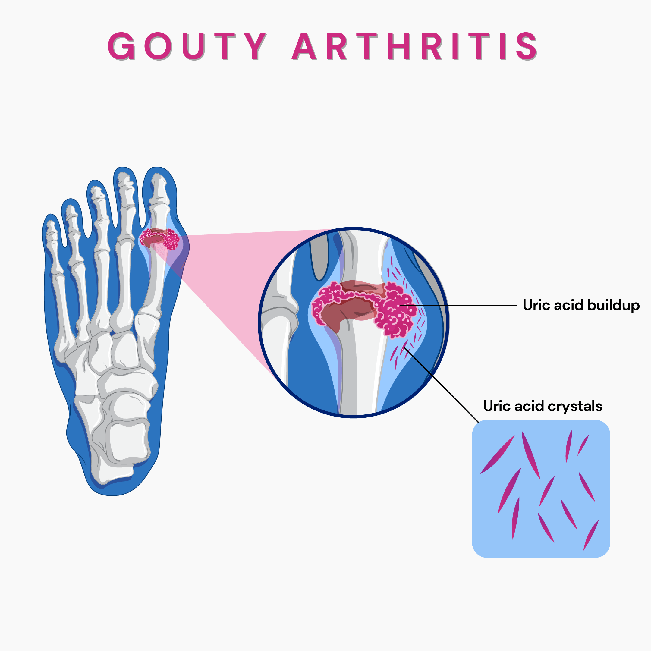 Is Gout Arthritis Hereditary