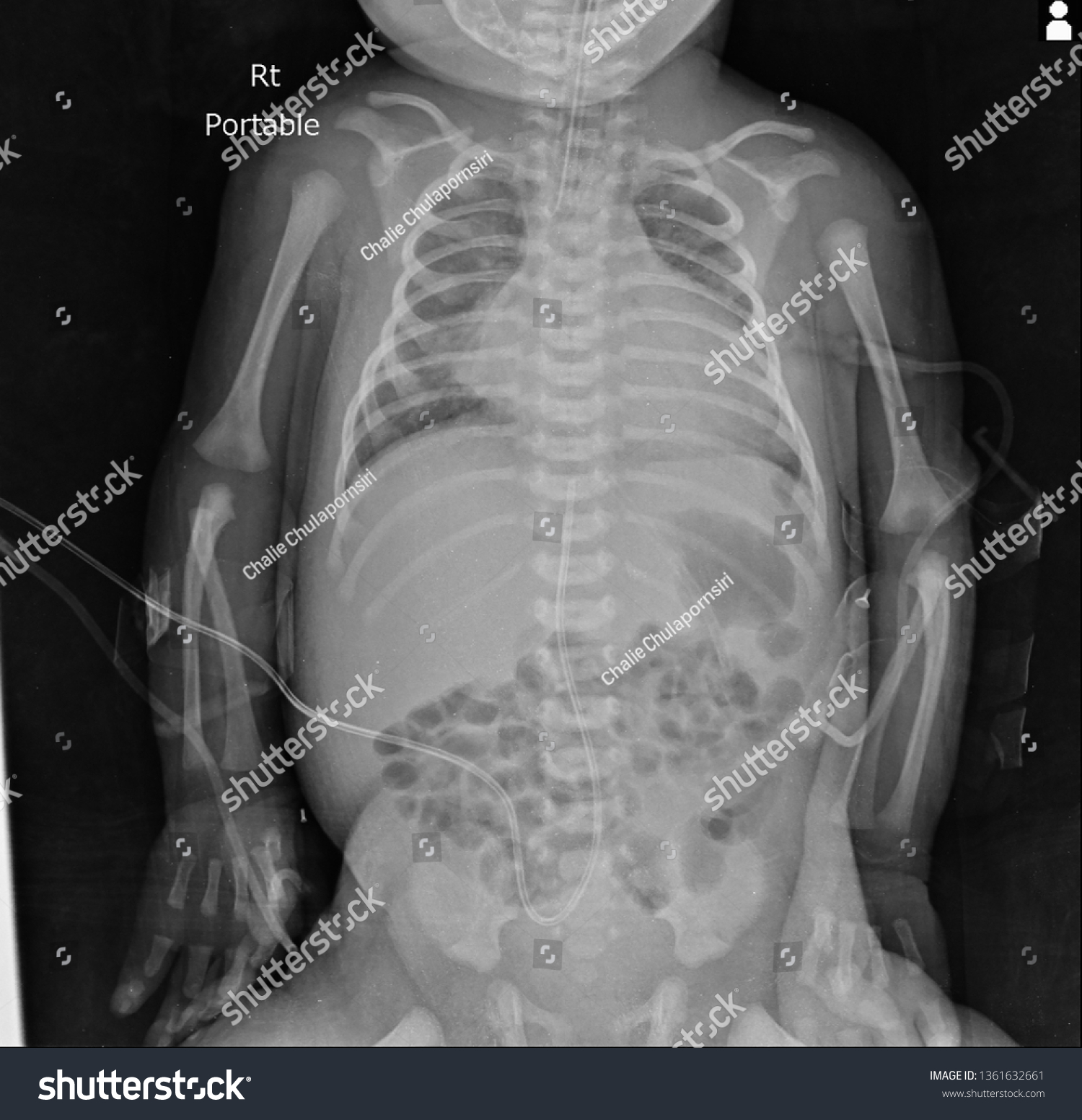 Is It Bad To Xray A Baby
