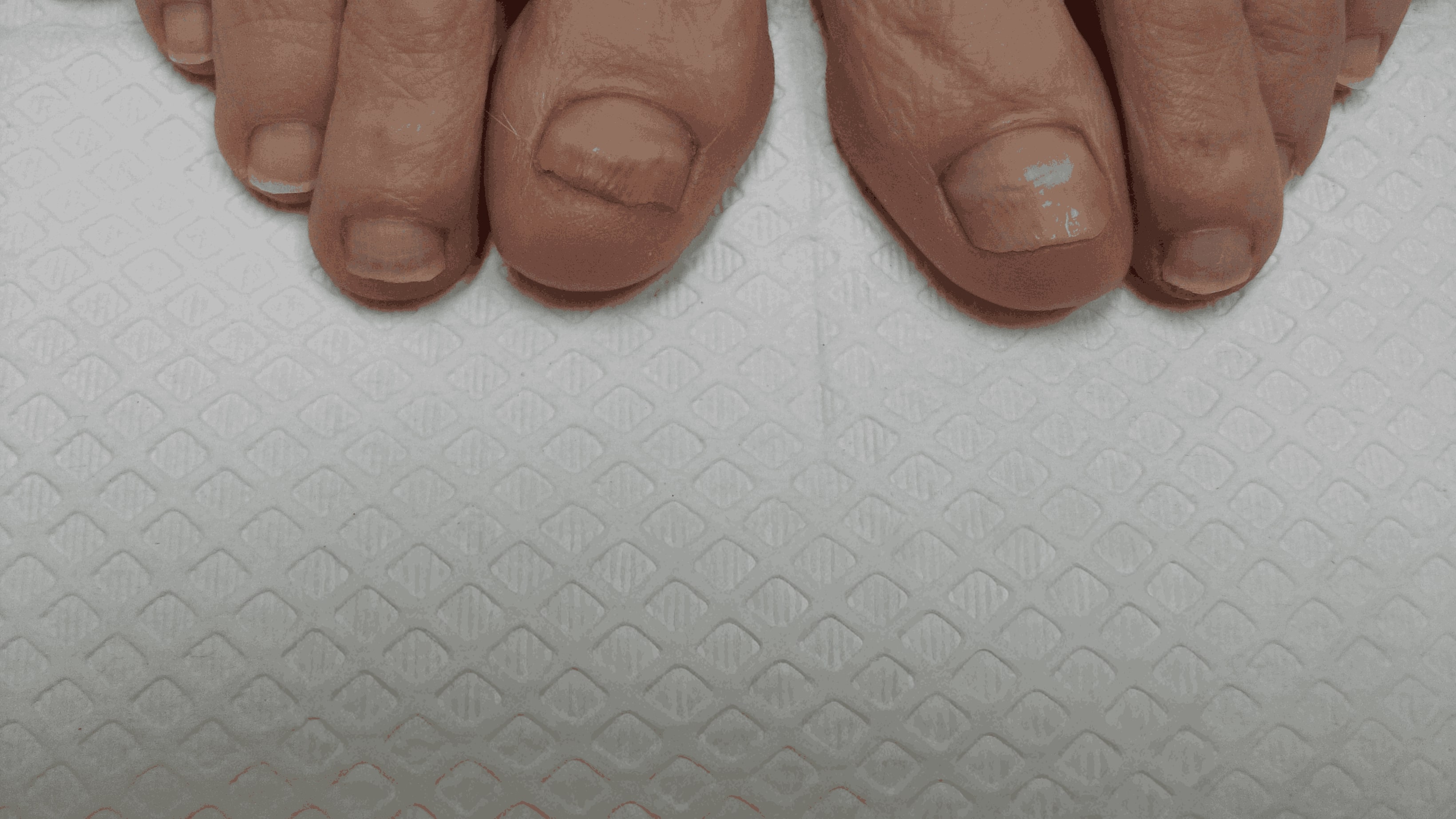 Is Nail Fungus Contagious