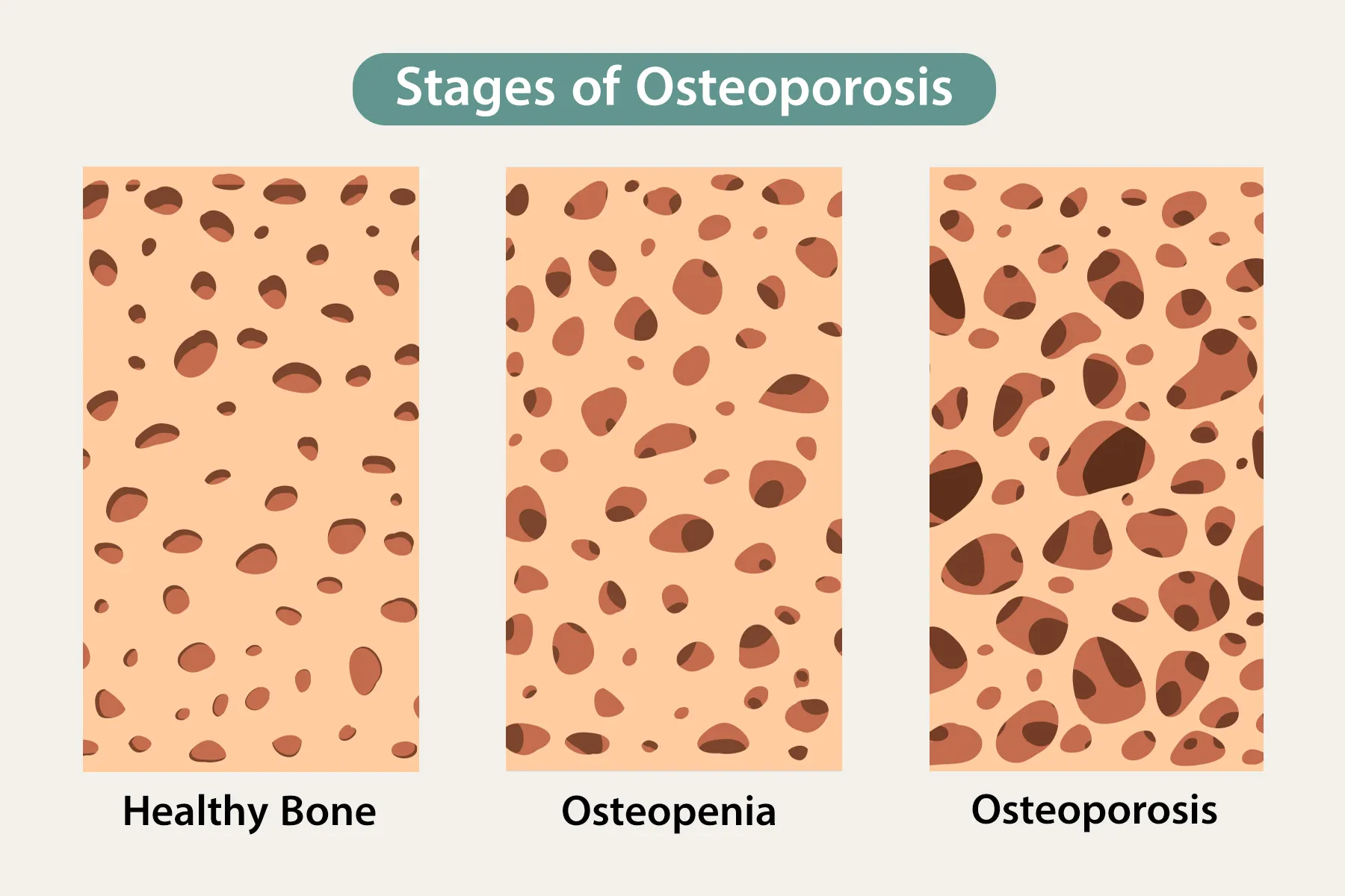 Is Osteopenia Reversible