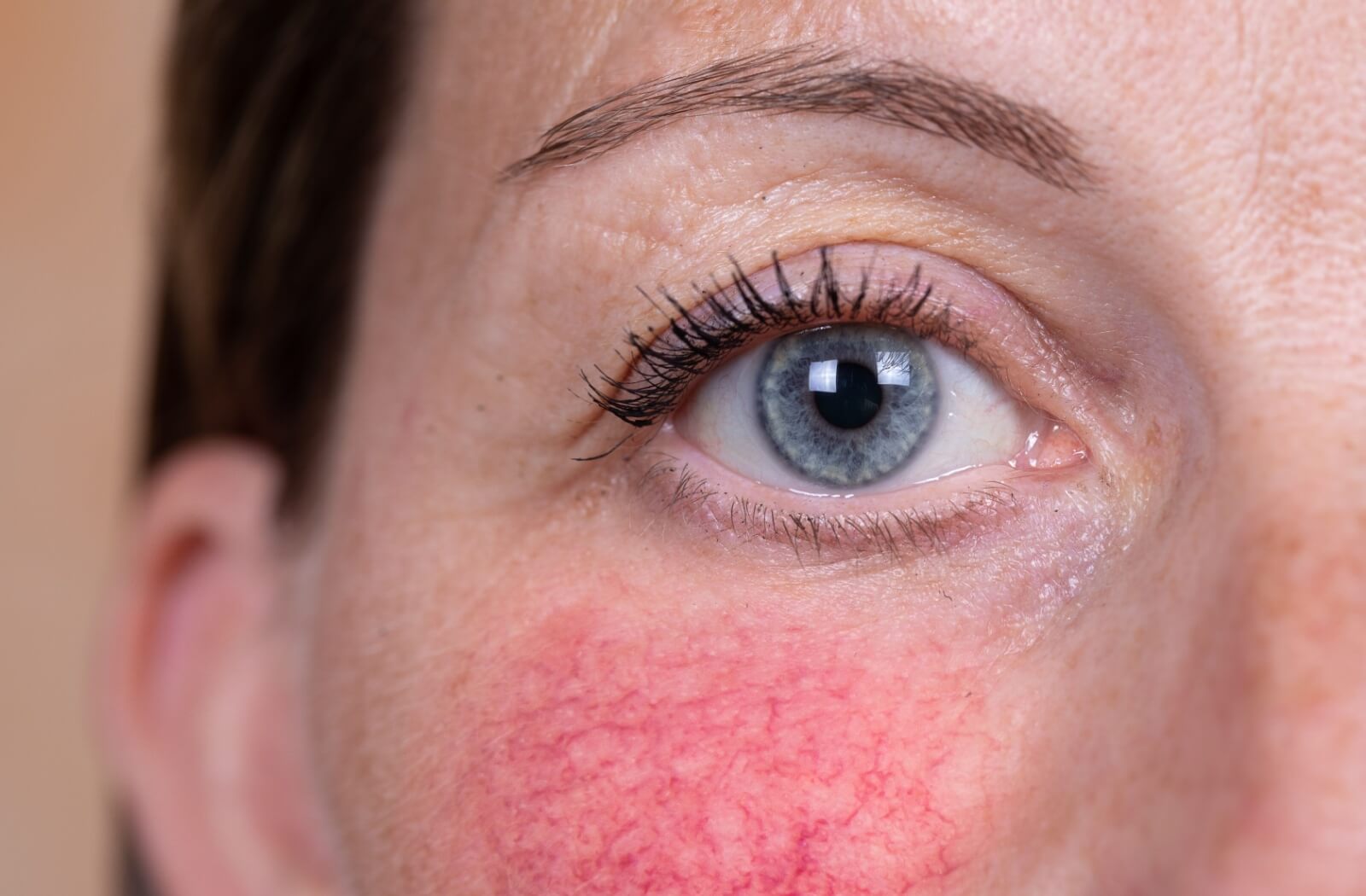 Is Rosacea Autoimmune