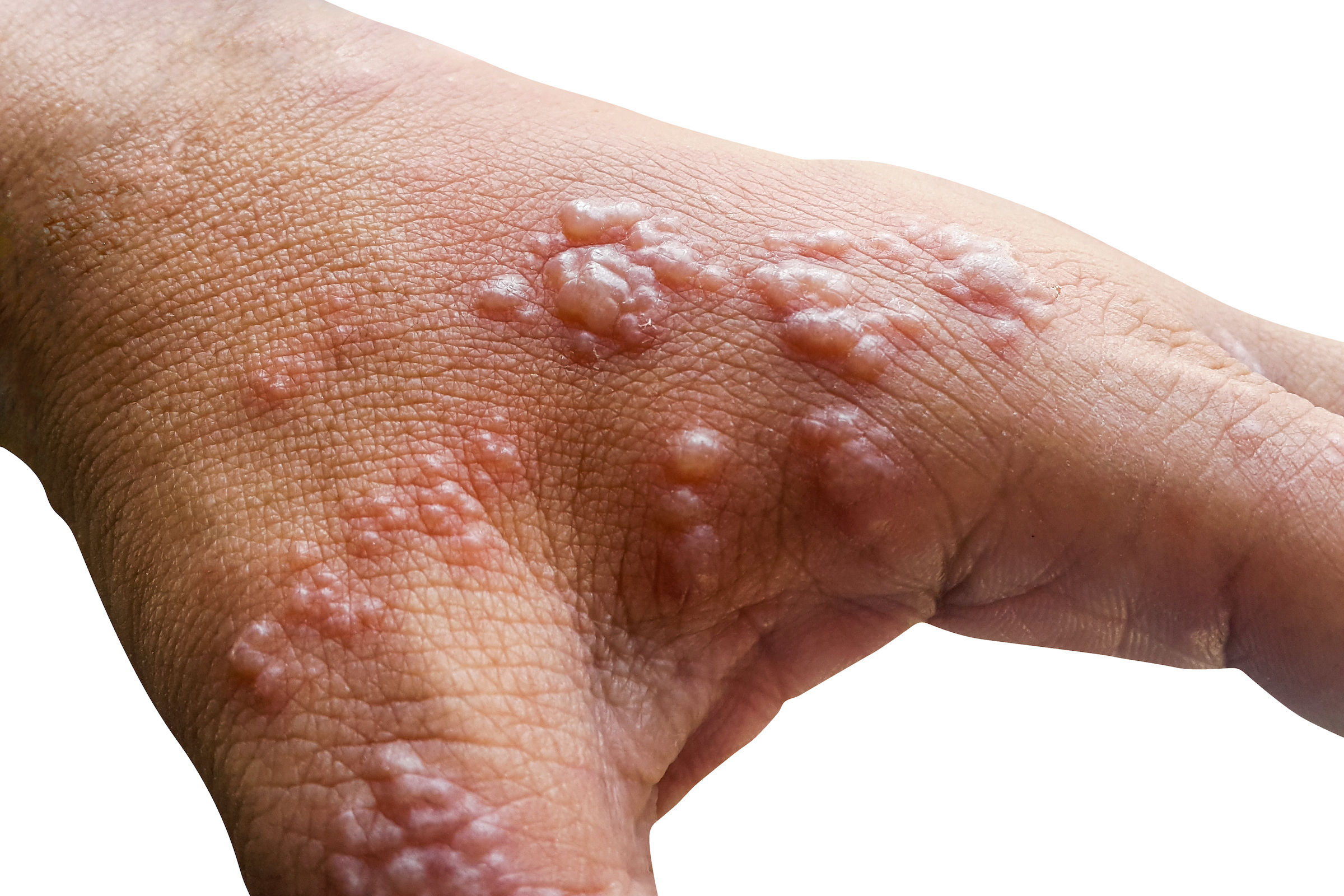 Is Shingles Airborne