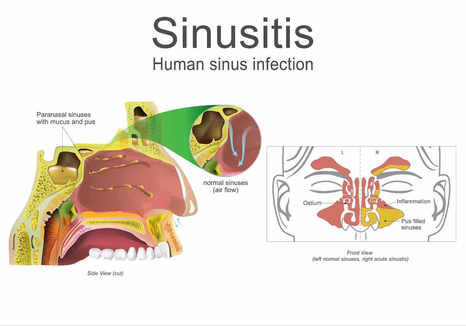 Is Sinusitis Contagious