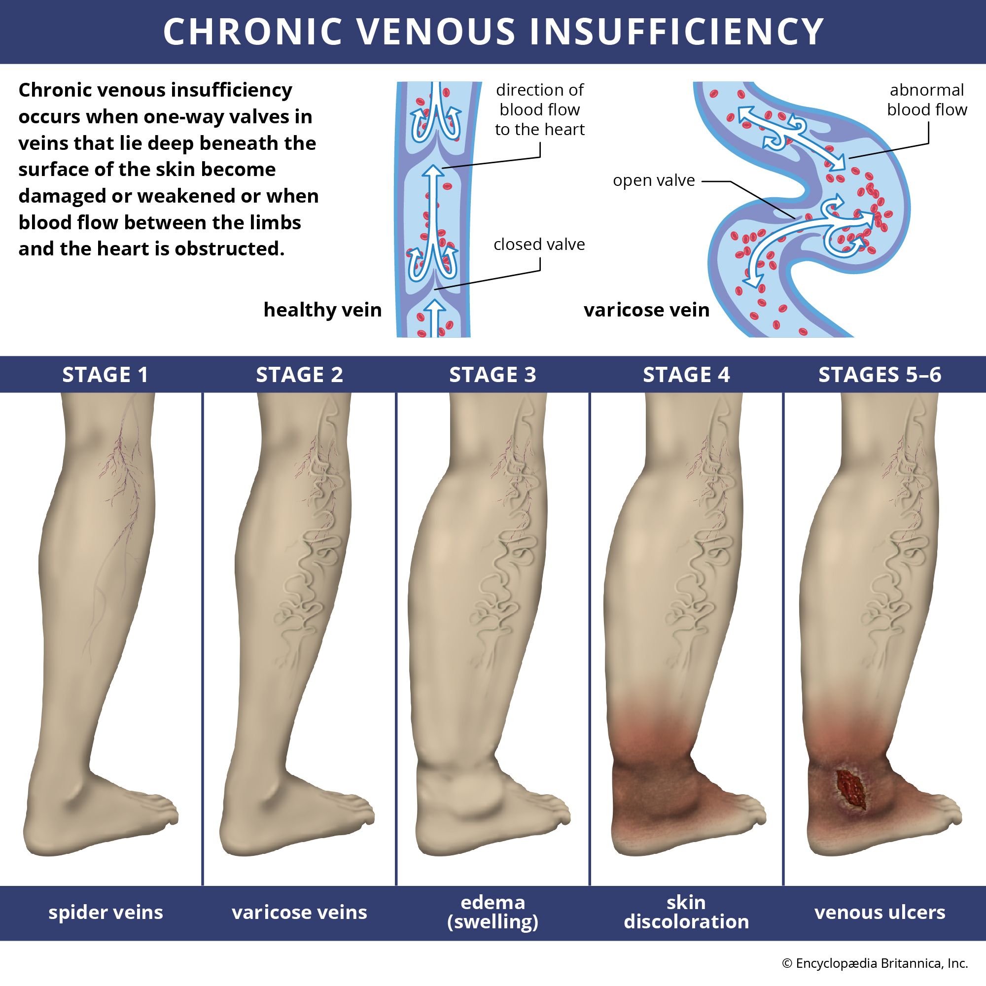 Is Venous Insufficiency Dangerous