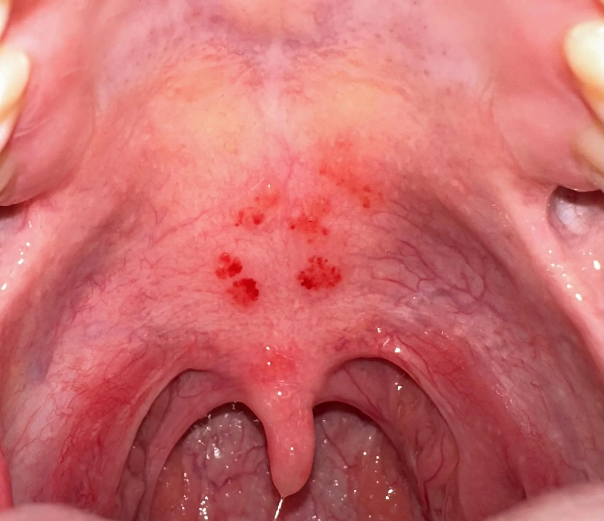Itch In Roof Of Mouth
