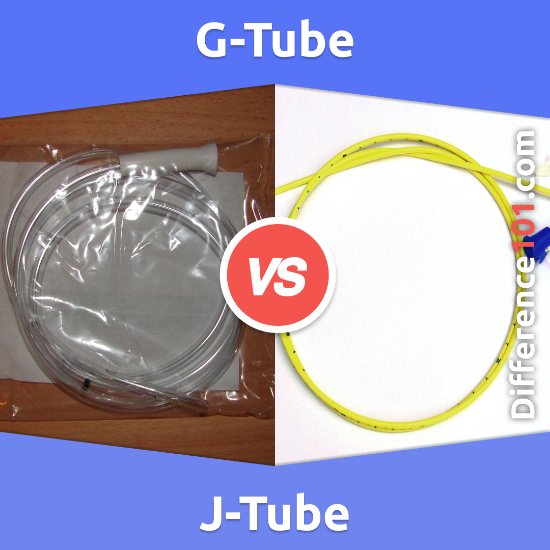 J Tube Vs G Tube