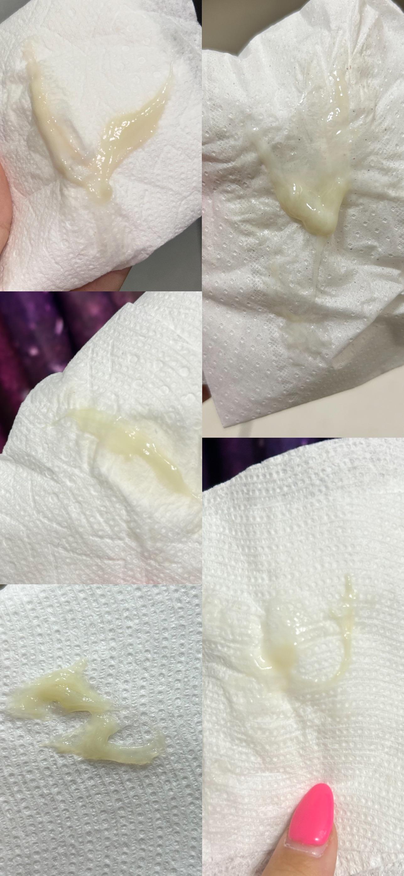 Jelly Like Discharge