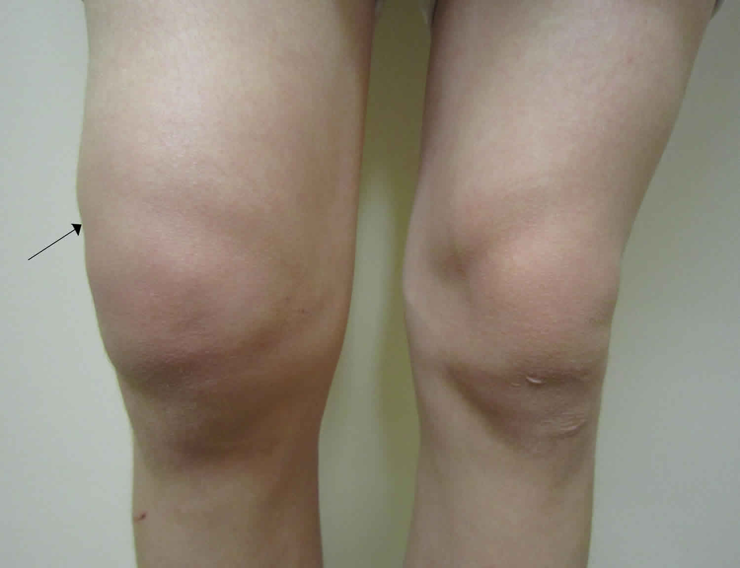 Joint Effusion Knee