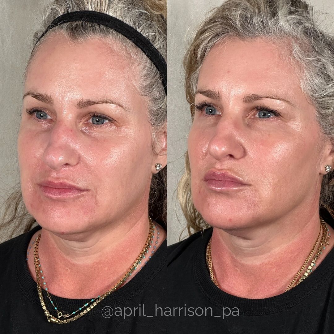 Joyce Meyer Face Surgery