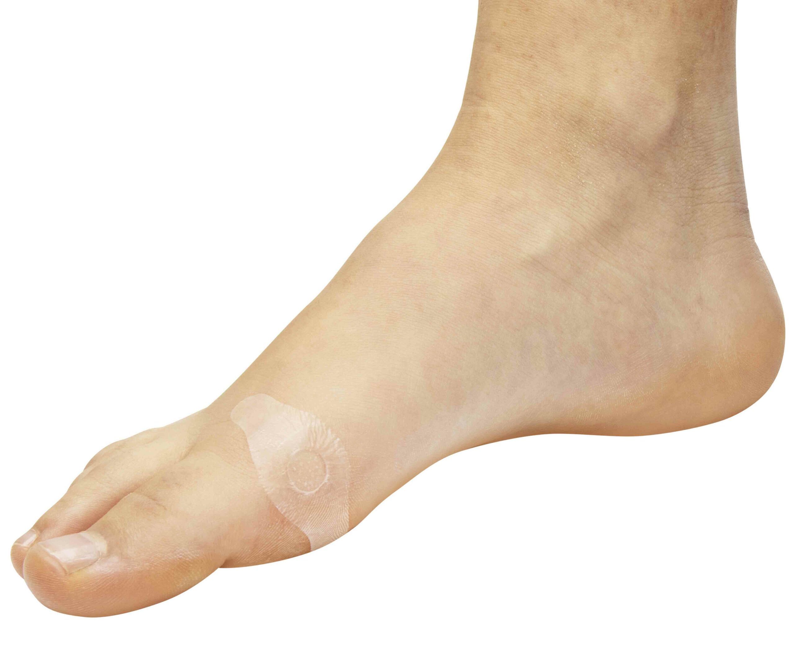 Juanetes En Los Pies