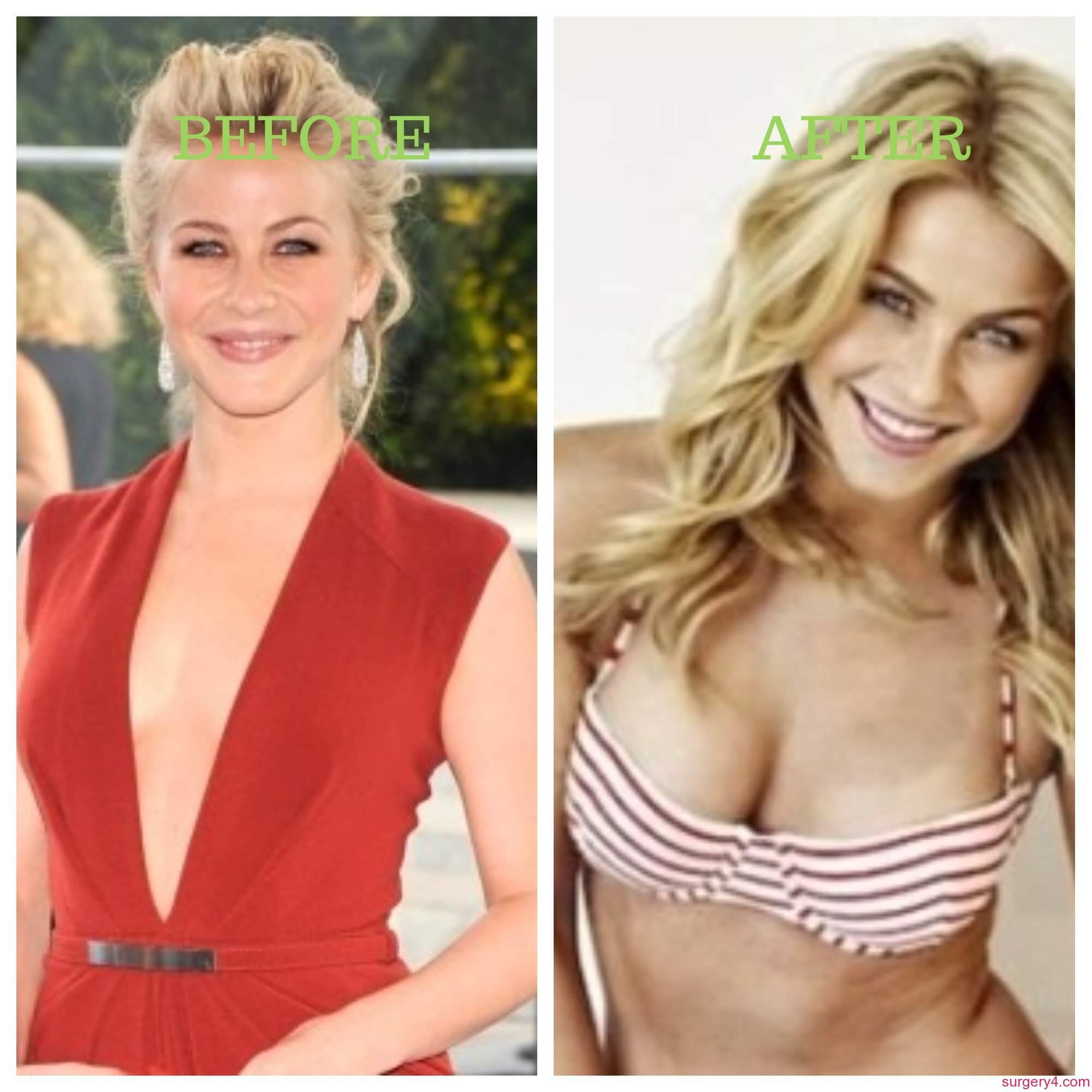 Julianne Hough Face Surgery