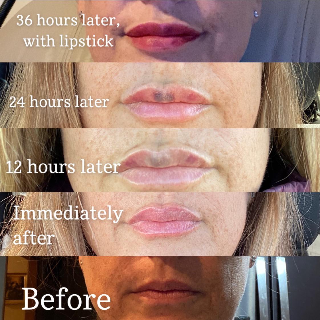 Juvederm Lip Injections