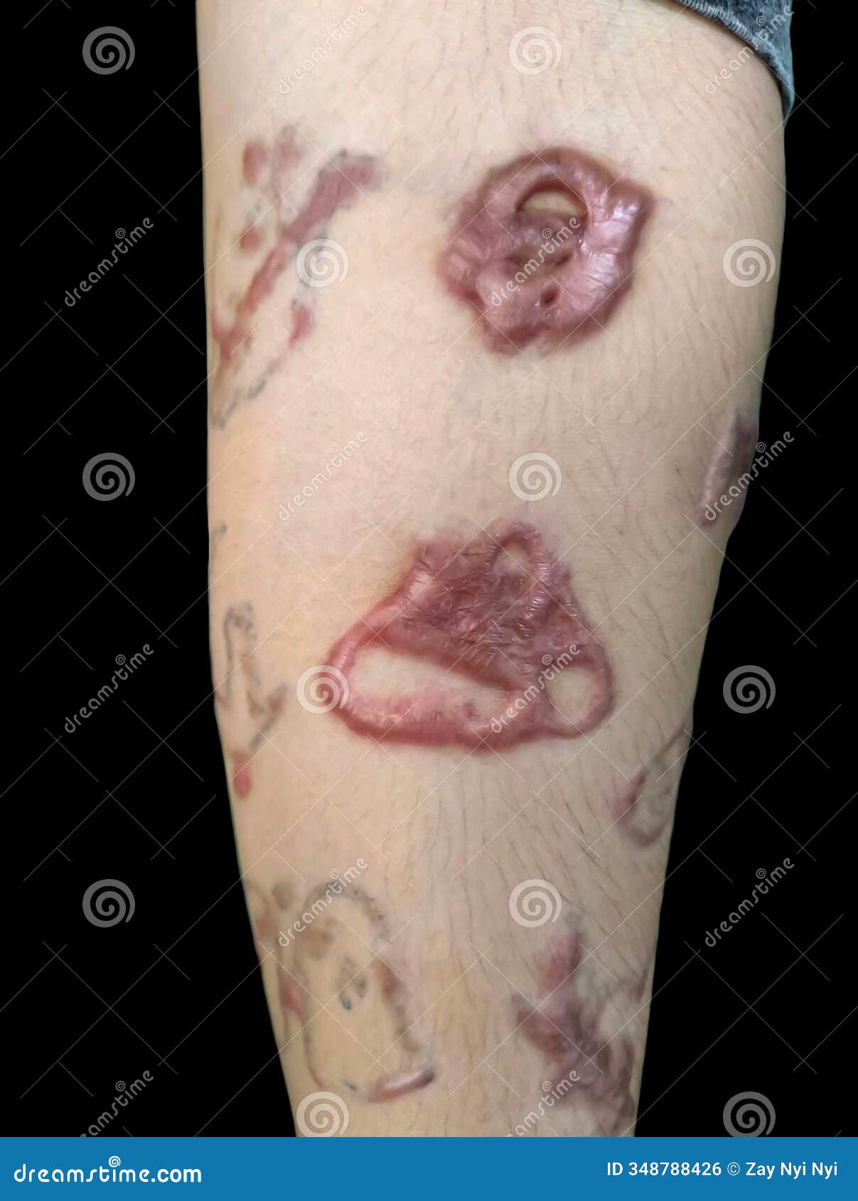 Keloid Scarring From Tattoos