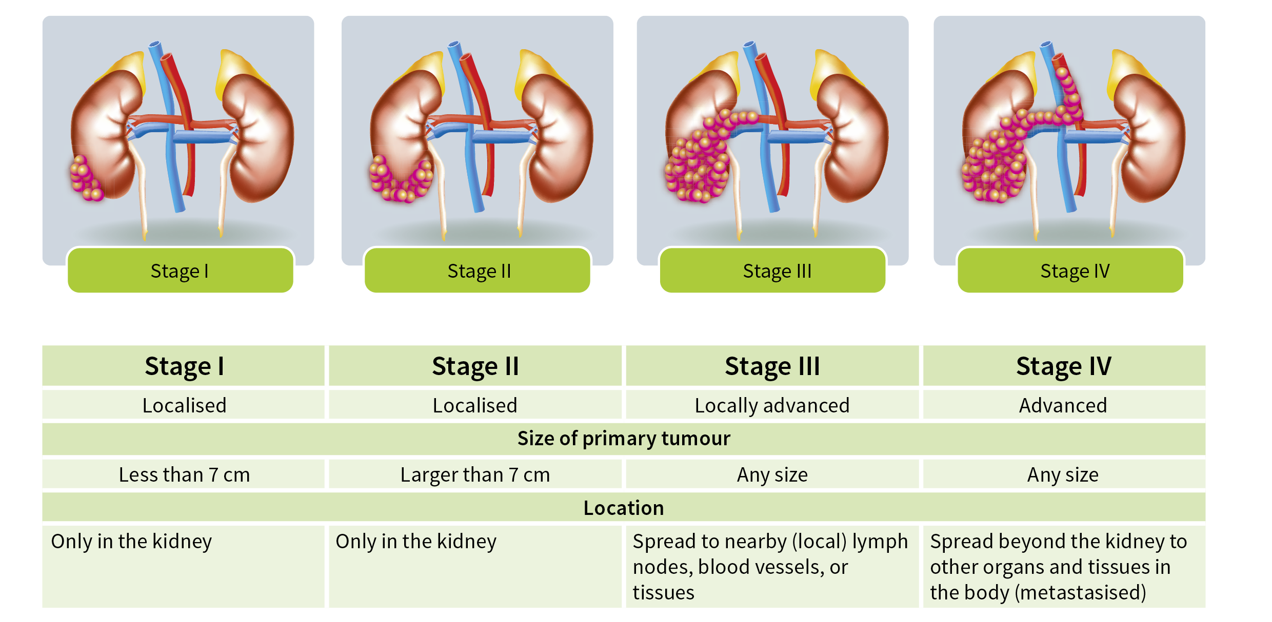 Kidney Carcinoma Staging